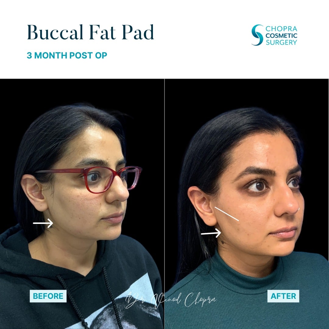 Buccal Fat Pad Removal Real Patient Results by Dr. Vinod Chopra in Washington, D.C. and Fairfax, VA