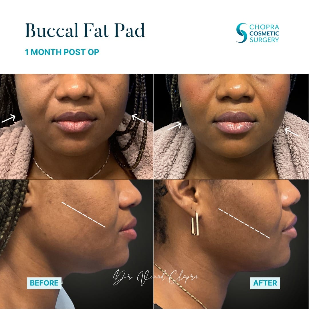 Buccal Fat Pad Removal Real Patient Results by Dr. Vinod Chopra in Washington, D.C. and Fairfax, VA