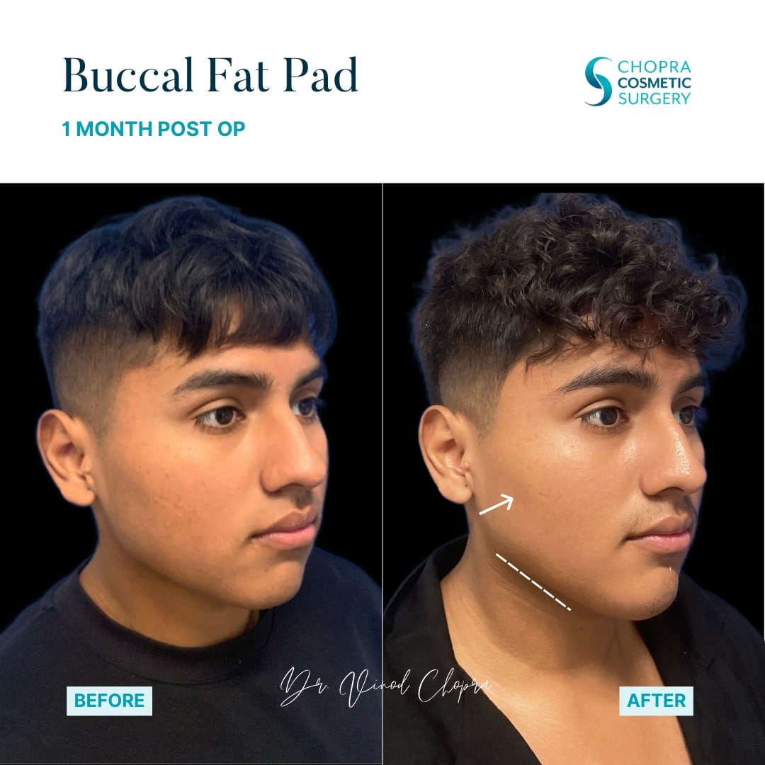 Buccal Fat Pad Removal Real Patient Results by Dr. Vinod Chopra in Washington, D.C. and Fairfax, VA