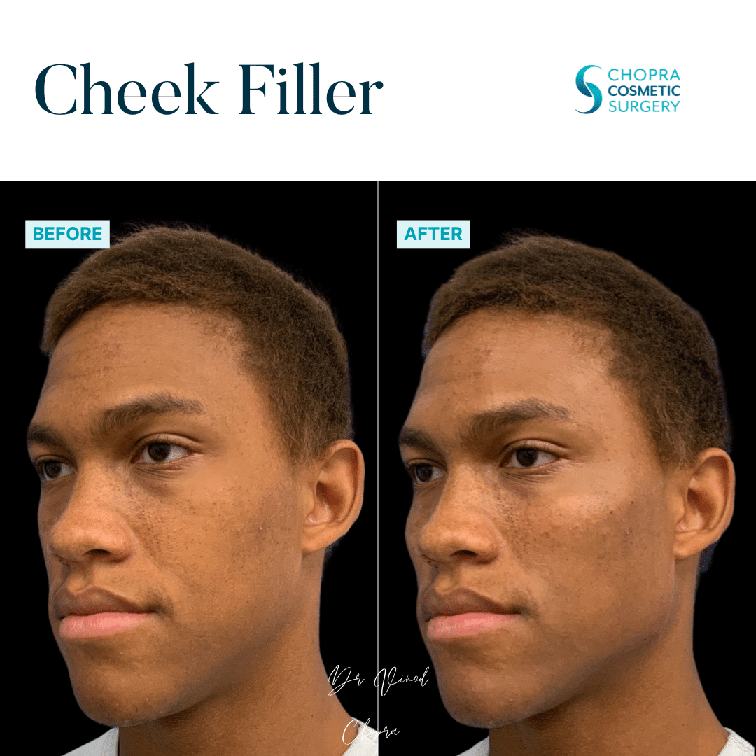 Cheek Filler Real Patient Results by Dr. Vinod Chopra in Washington, D.C. and Fairfax, VA