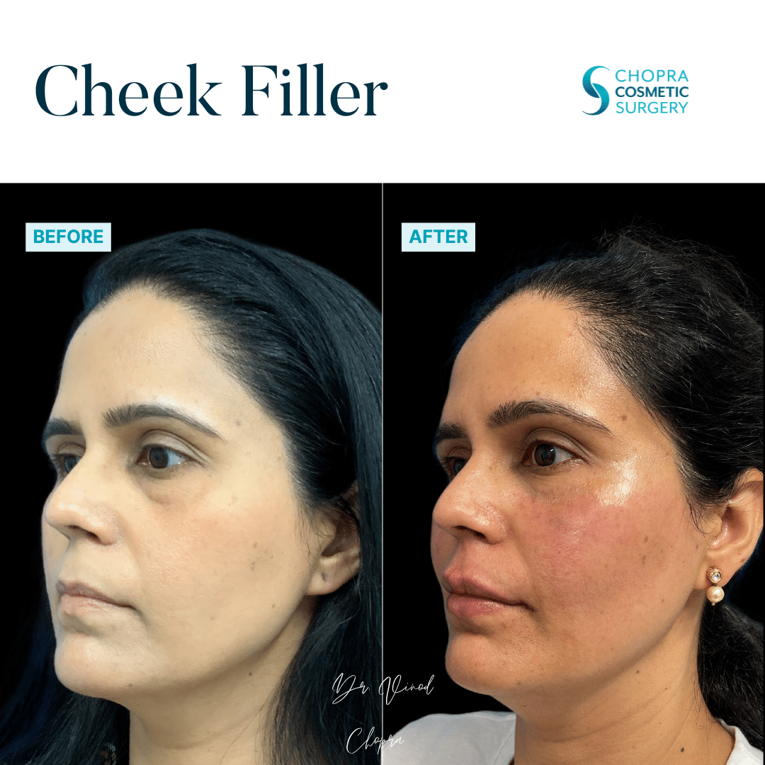 Cheek Filler Real Patient Results by Dr. Vinod Chopra in Washington, D.C. and Fairfax, VA