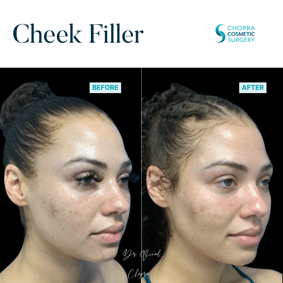 Cheek Filler Real Patient Results by Dr. Vinod Chopra in Washington, D.C. and Fairfax, VA