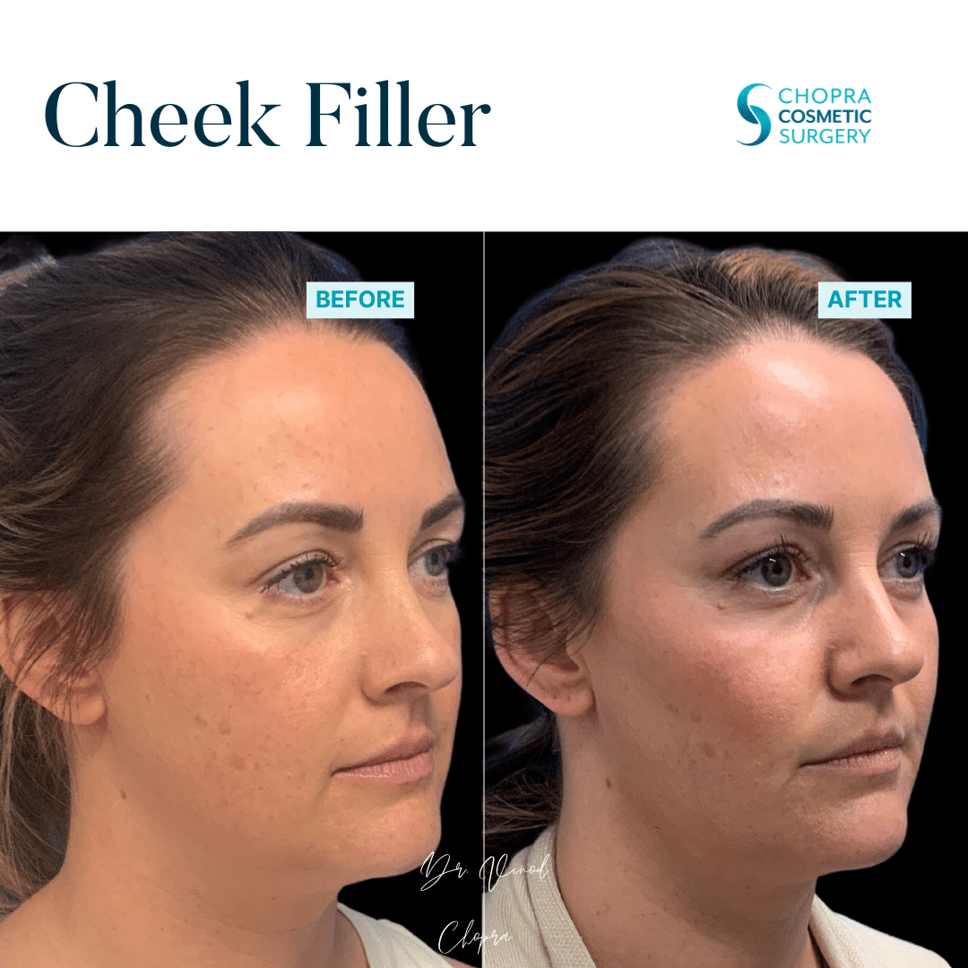 Cheek Filler Real Patient Results by Dr. Vinod Chopra in Washington, D.C. and Fairfax, VA