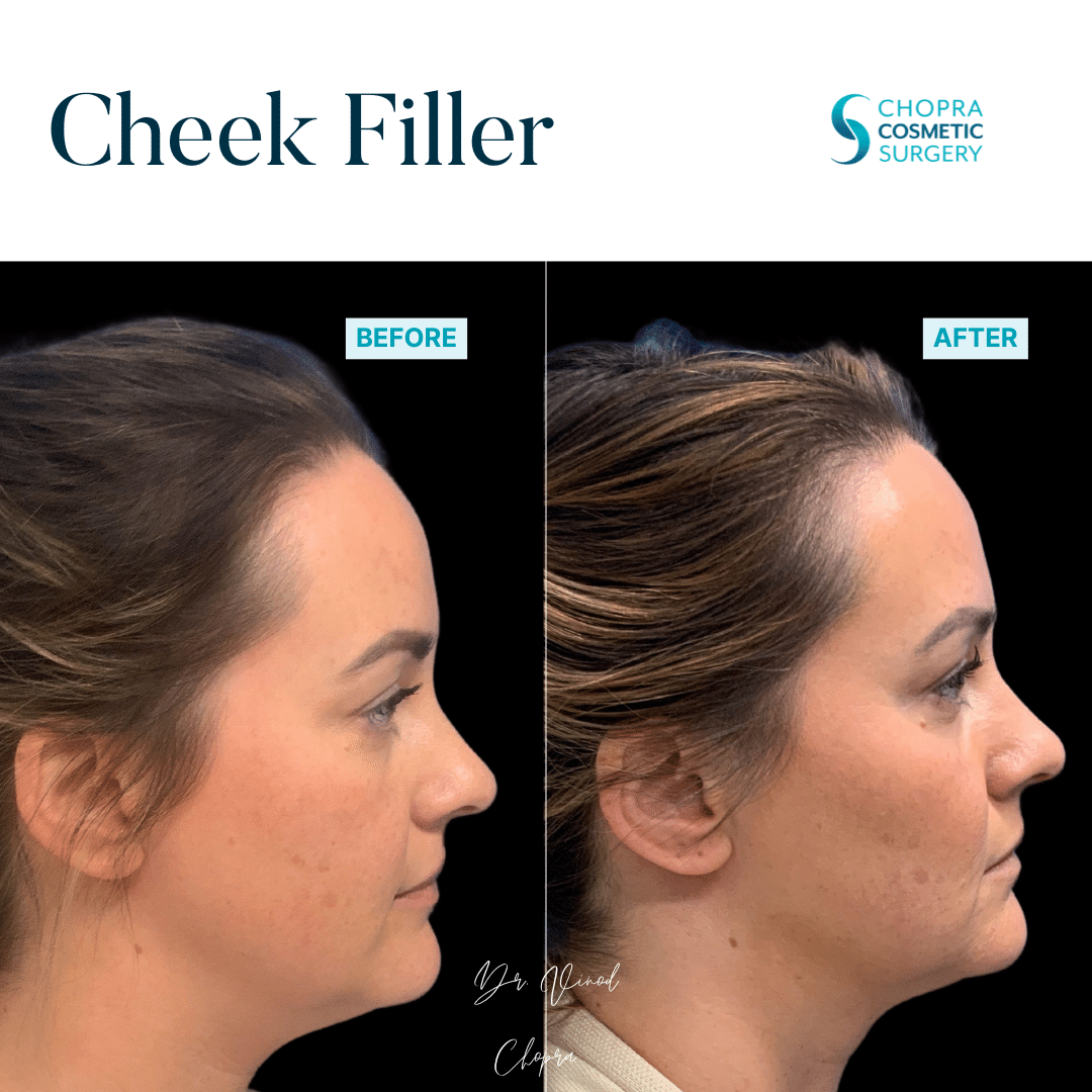 Cheek Filler Real Patient Results by Dr. Vinod Chopra in Washington, D.C. and Fairfax, VA