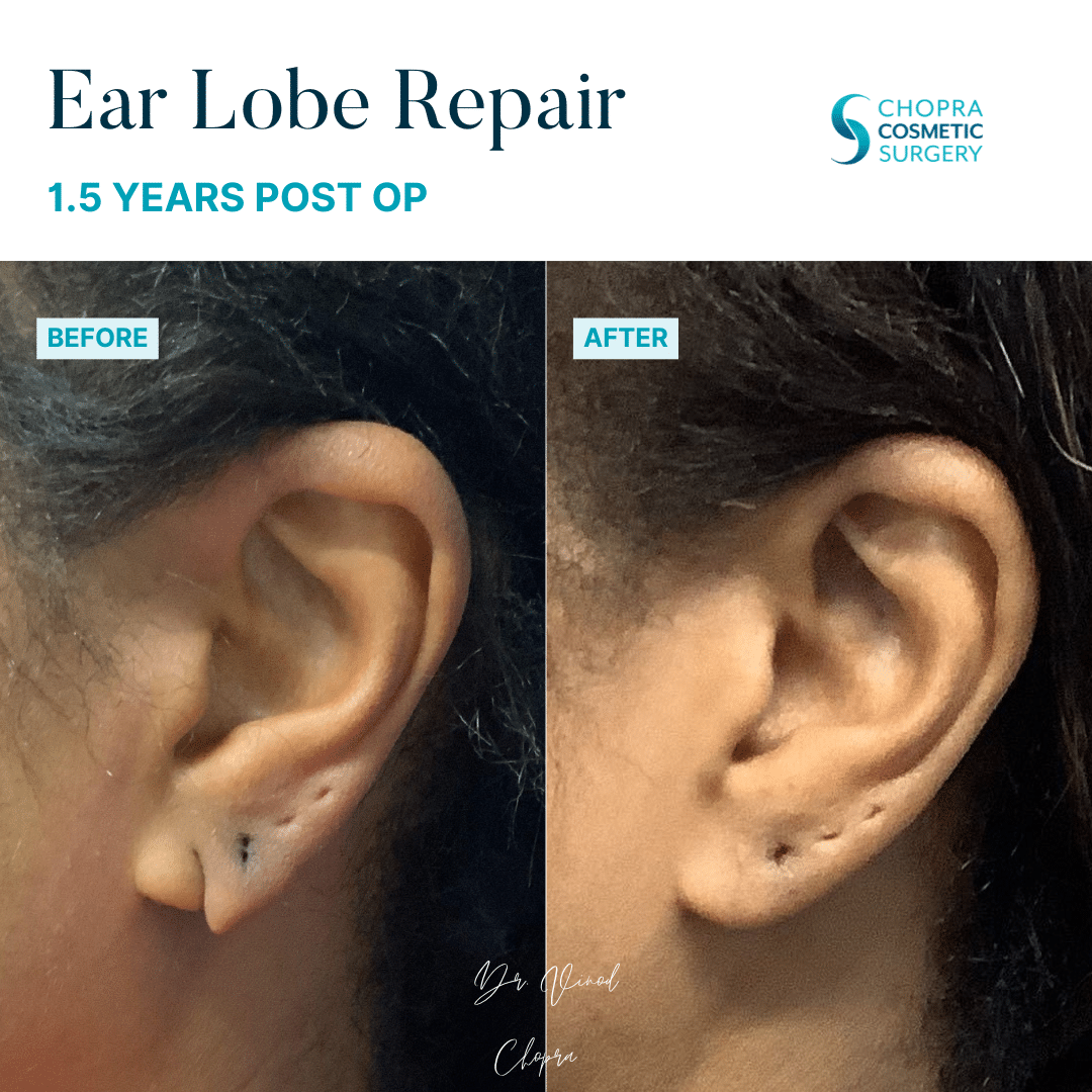 Earlobe Repair Real Patient Results by Dr. Vinod Chopra in Washington, D.C. and Fairfax, VA