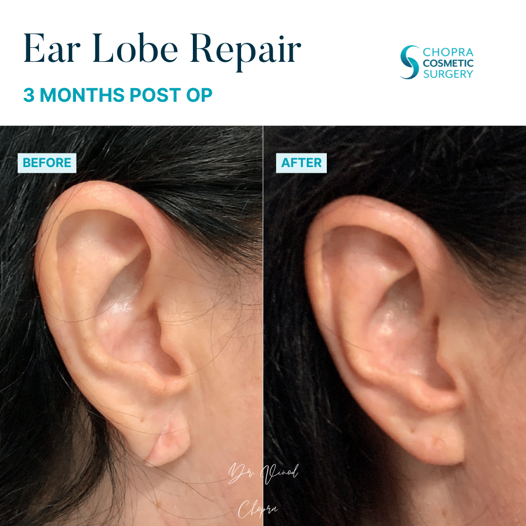 Earlobe Repair Real Patient Results by Dr. Vinod Chopra in Washington, D.C. and Fairfax, VA