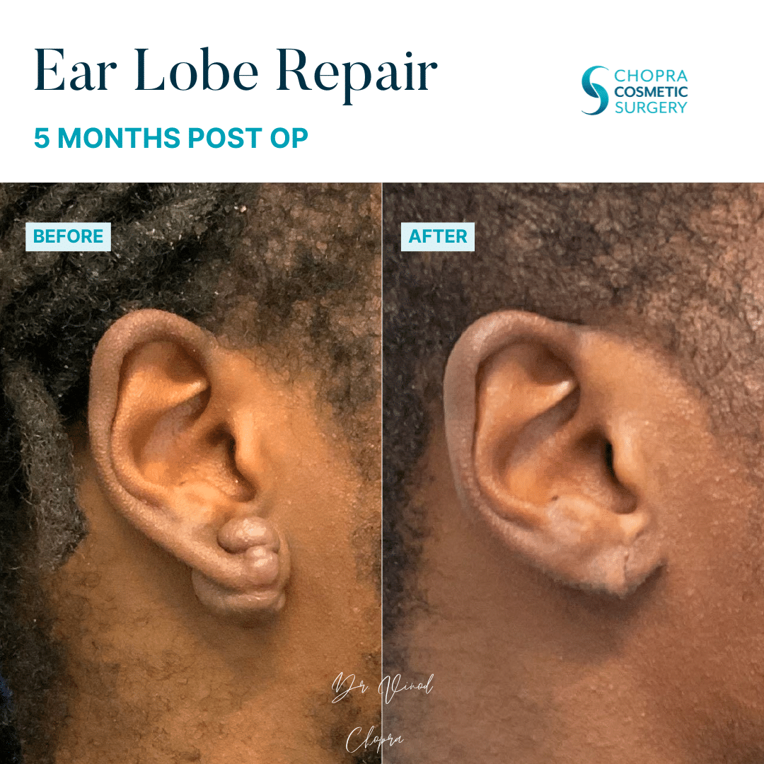 Earlobe Repair Real Patient Results by Dr. Vinod Chopra in Washington, D.C. and Fairfax, VA