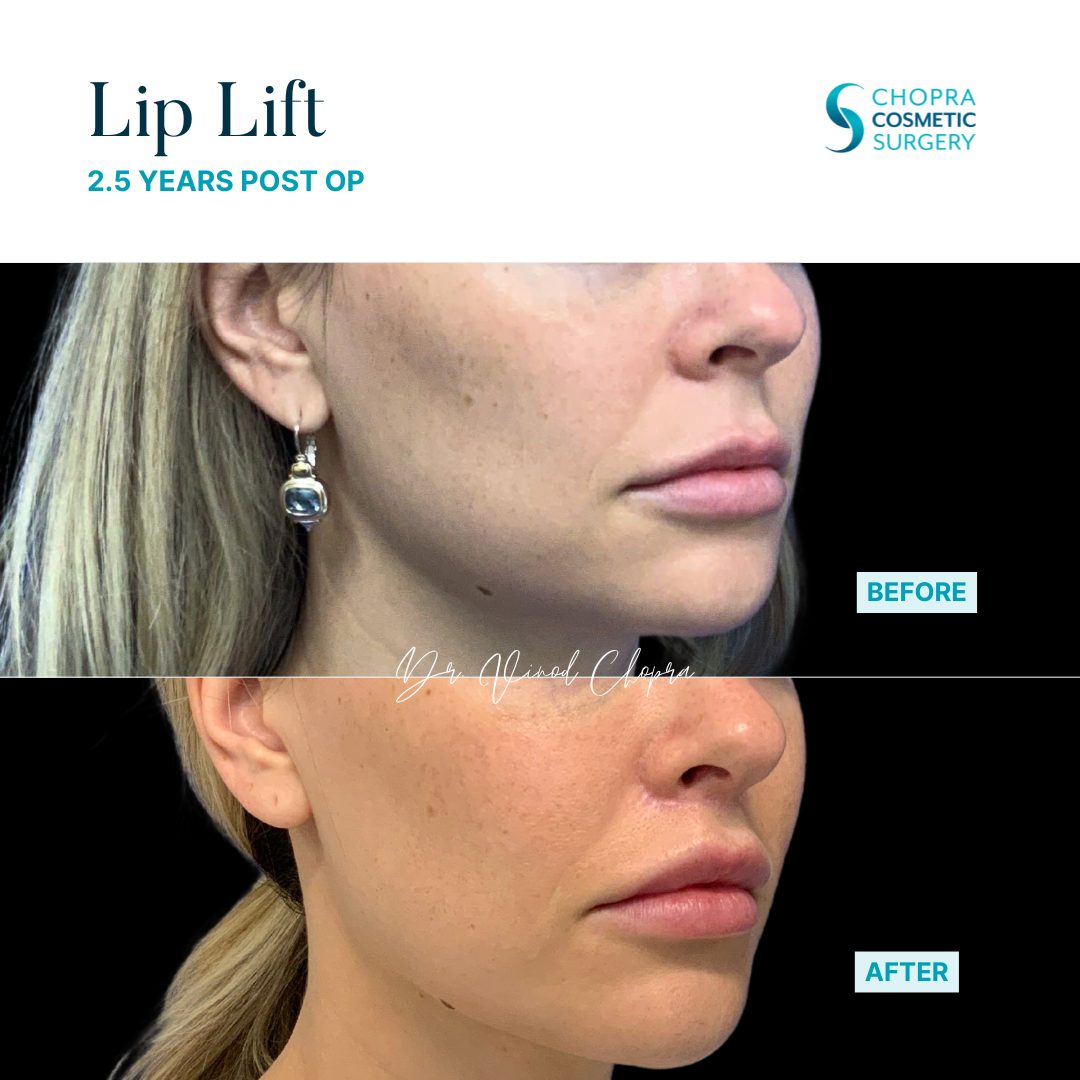Lip Lift Real Patient Results by Dr. Vinod Chopra in Washington, D.C. and Fairfax, VA