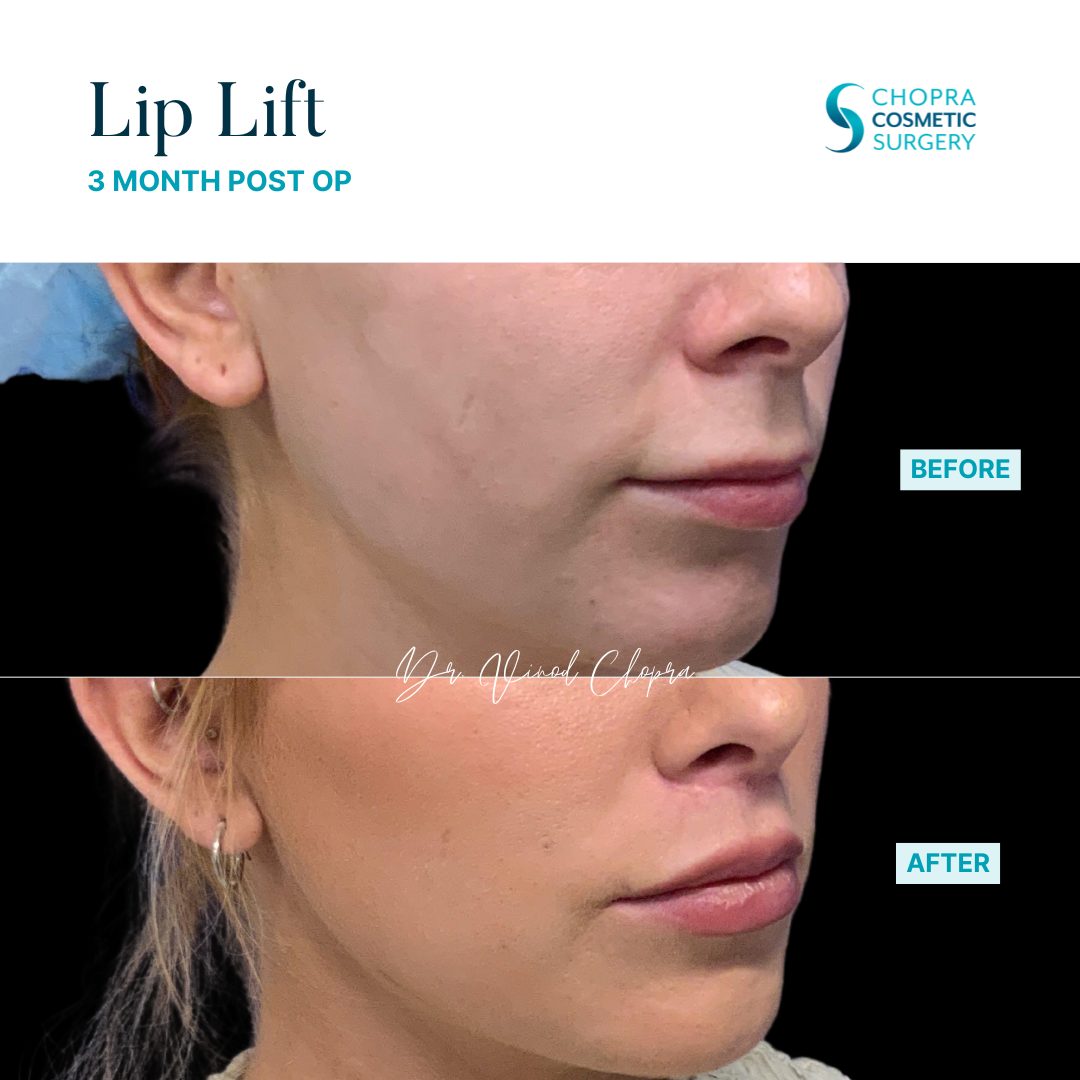 Lip Lift Real Patient Results by Dr. Vinod Chopra in Washington, D.C. and Fairfax, VA