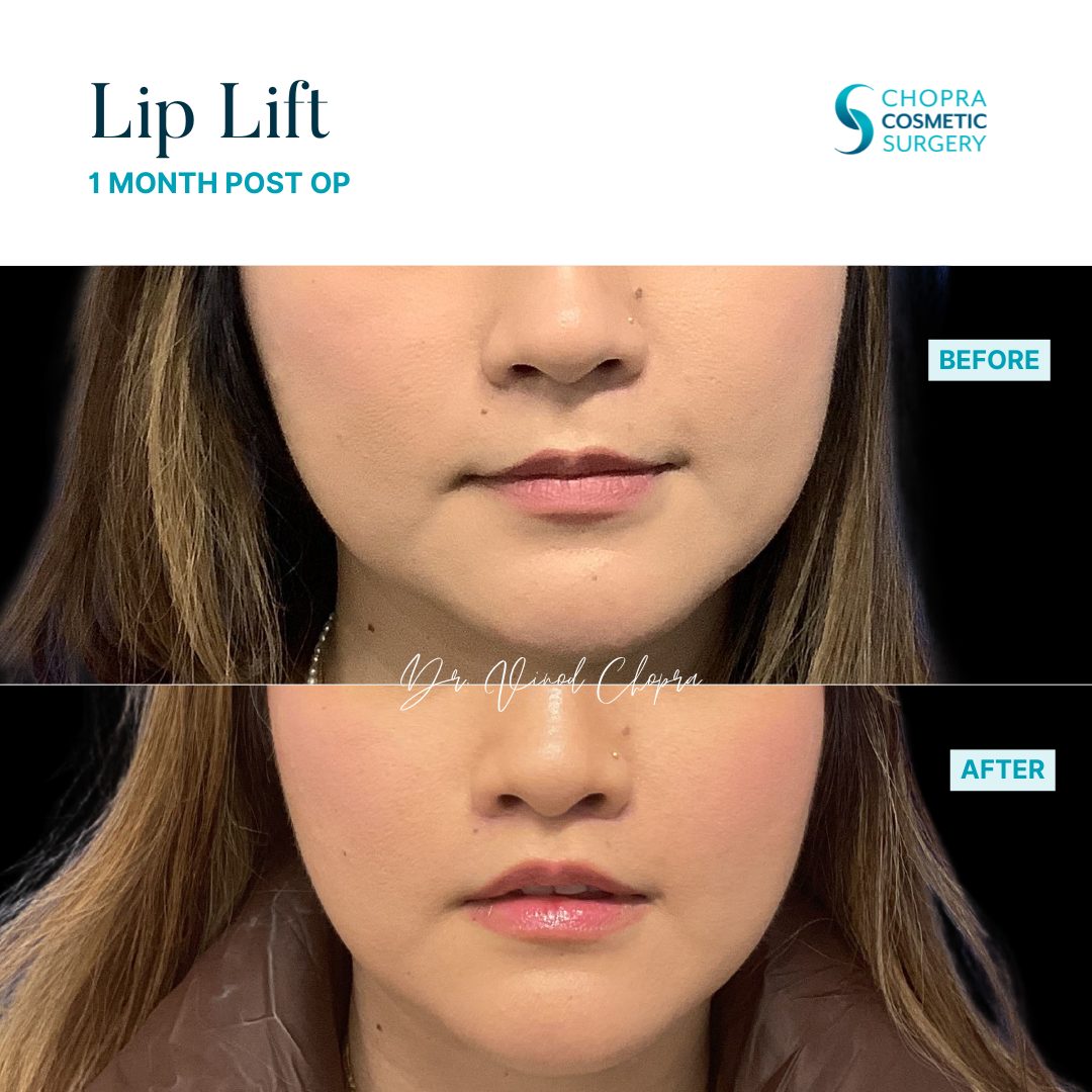 Lip Lift Real Patient Results by Dr. Vinod Chopra in Washington, D.C. and Fairfax, VA