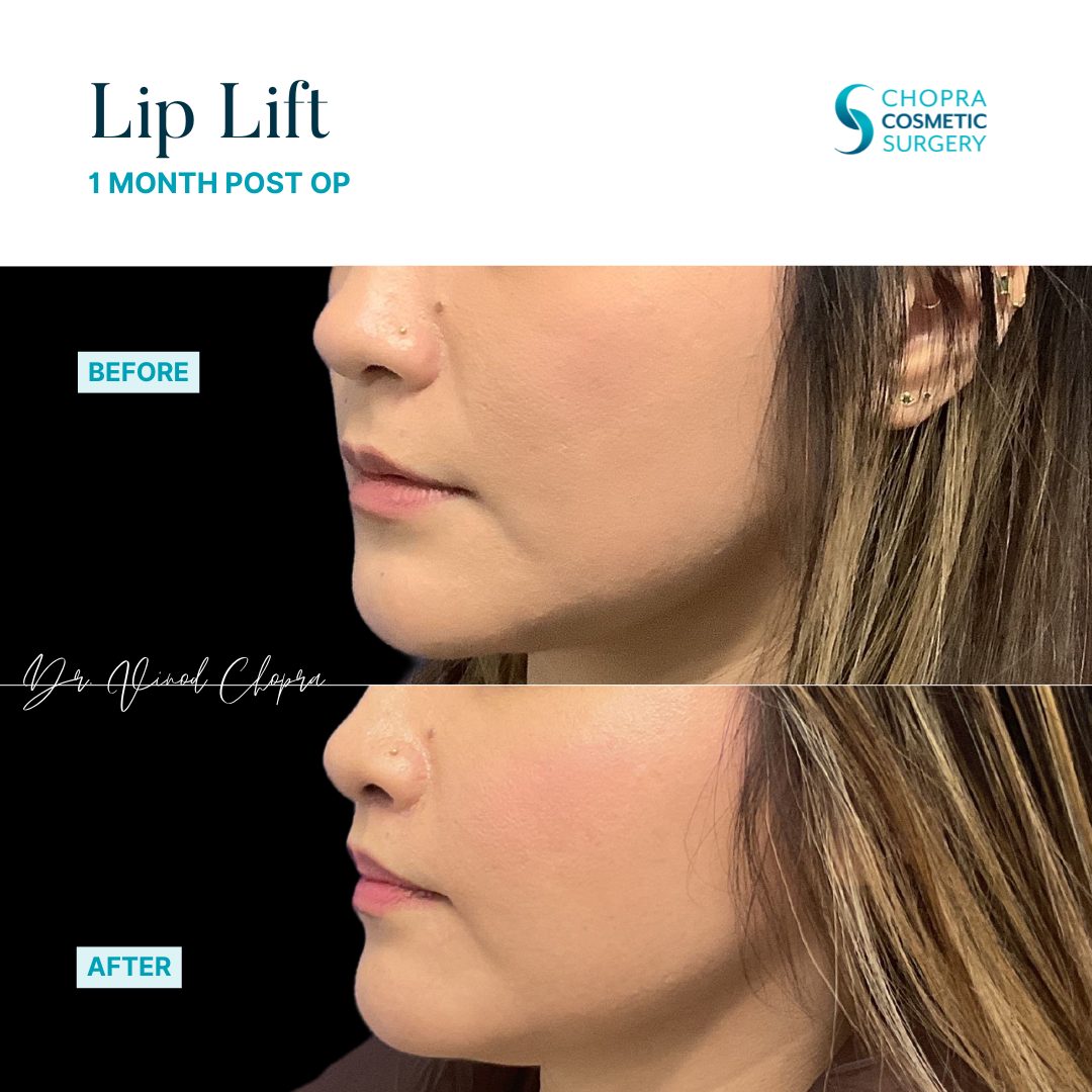 Lip Lift Real Patient Results by Dr. Vinod Chopra in Washington, D.C. and Fairfax, VA