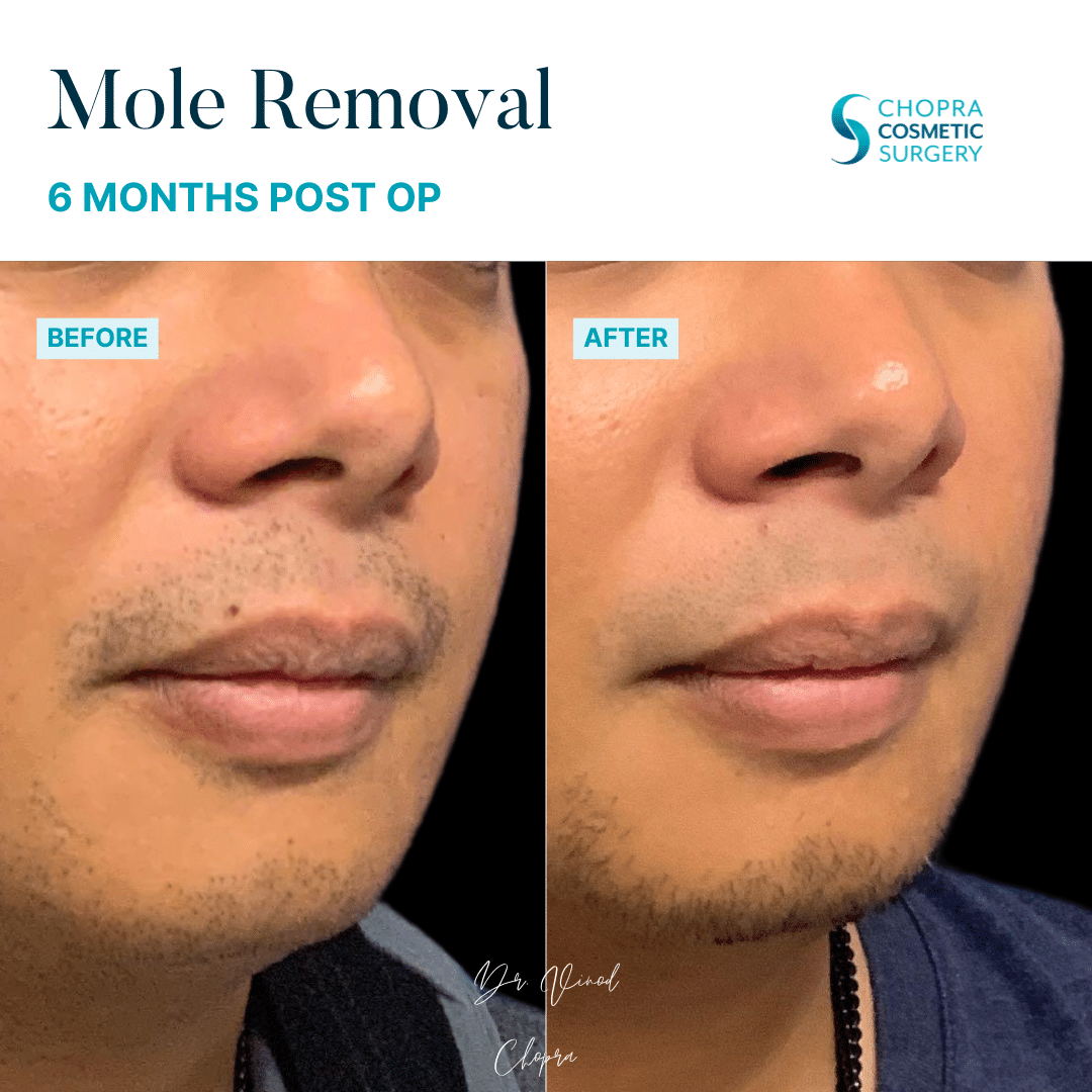 Mole Removal Patient Results by Dr. Vinod Chopra in Washington, D.C. and Fairfax, VA