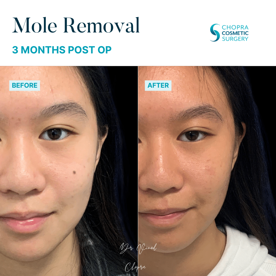Mole Removal Patient Results by Dr. Vinod Chopra in Washington, D.C. and Fairfax, VA