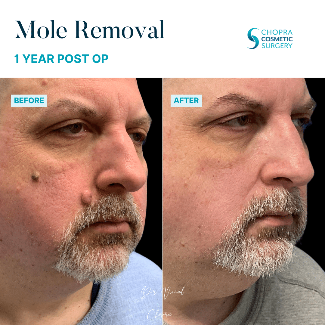 Mole Removal Patient Results by Dr. Vinod Chopra in Washington, D.C. and Fairfax, VA