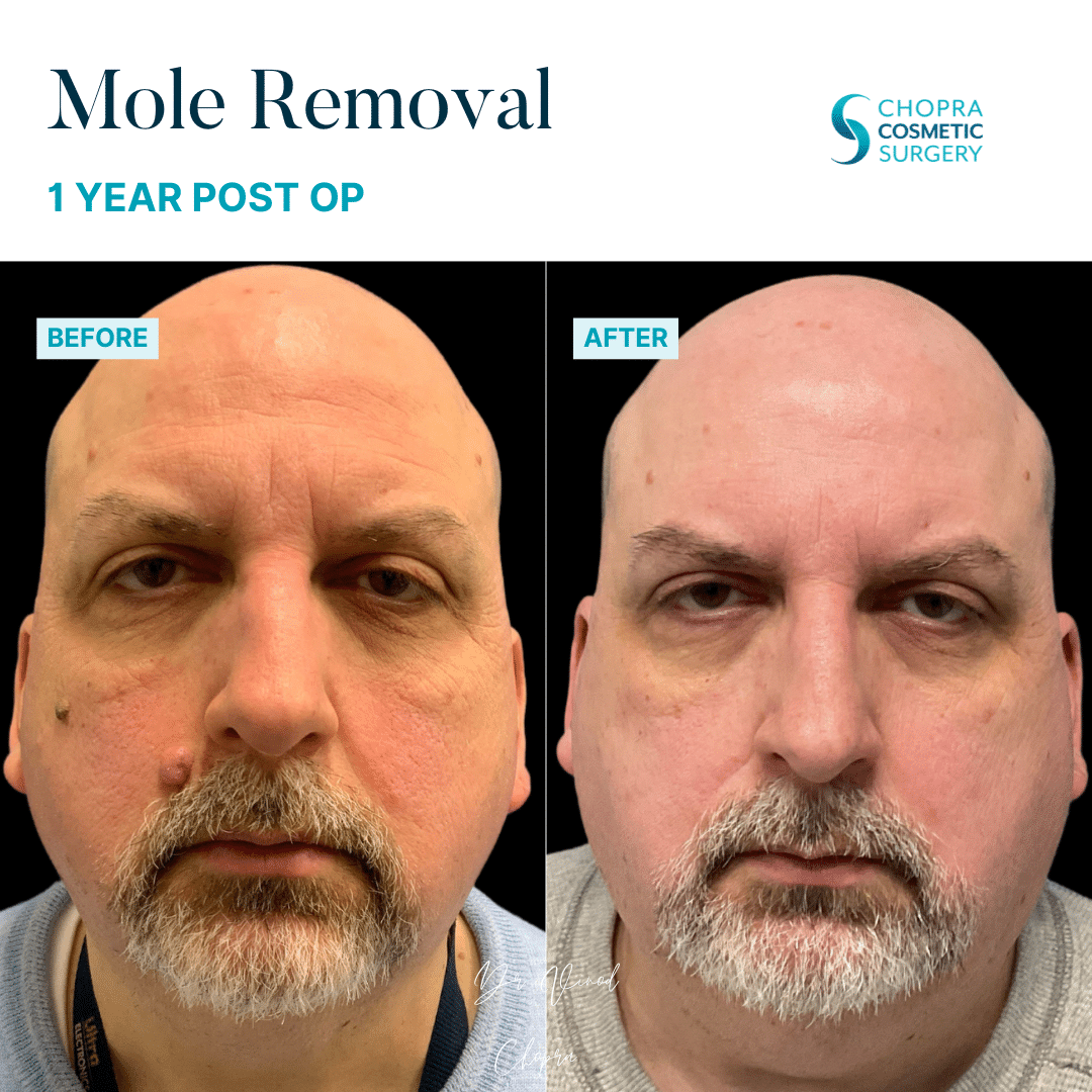 Mole Removal Patient Results by Dr. Vinod Chopra in Washington, D.C. and Fairfax, VA