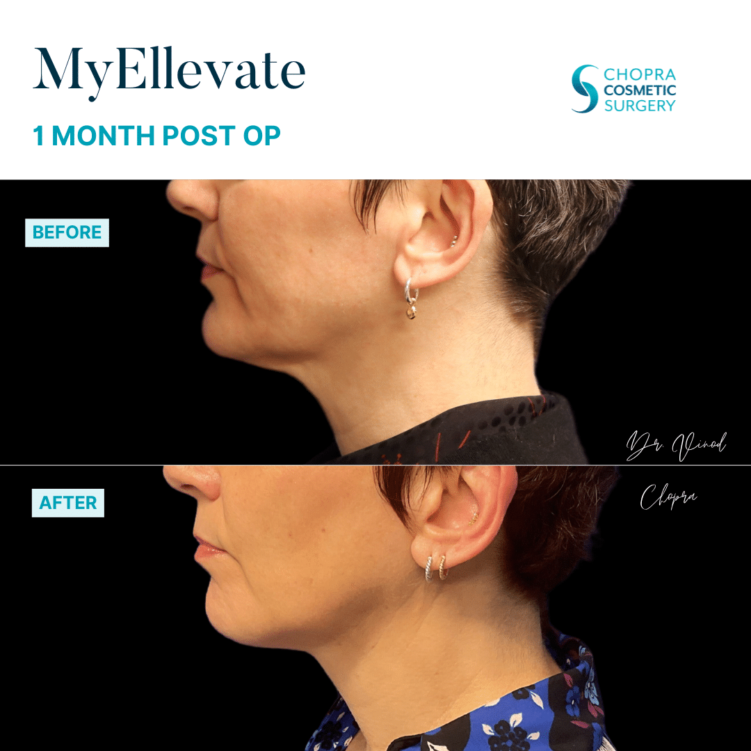 MyEllevate Neck Lift Patient Results by Dr. Vinod Chopra in Washington, D.C. and Fairfax, VA