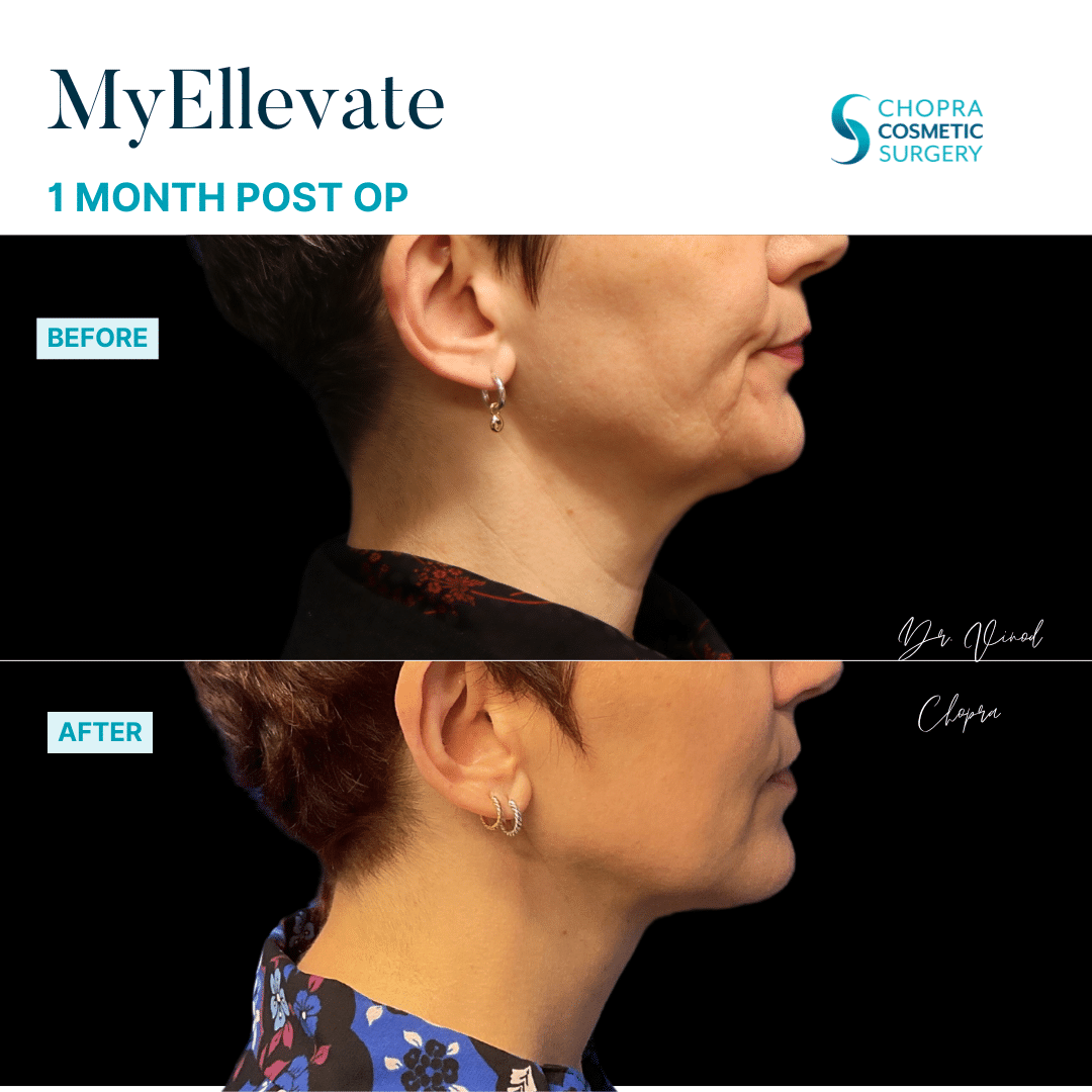 MyEllevate Neck Lift Patient Results by Dr. Vinod Chopra in Washington, D.C. and Fairfax, VA