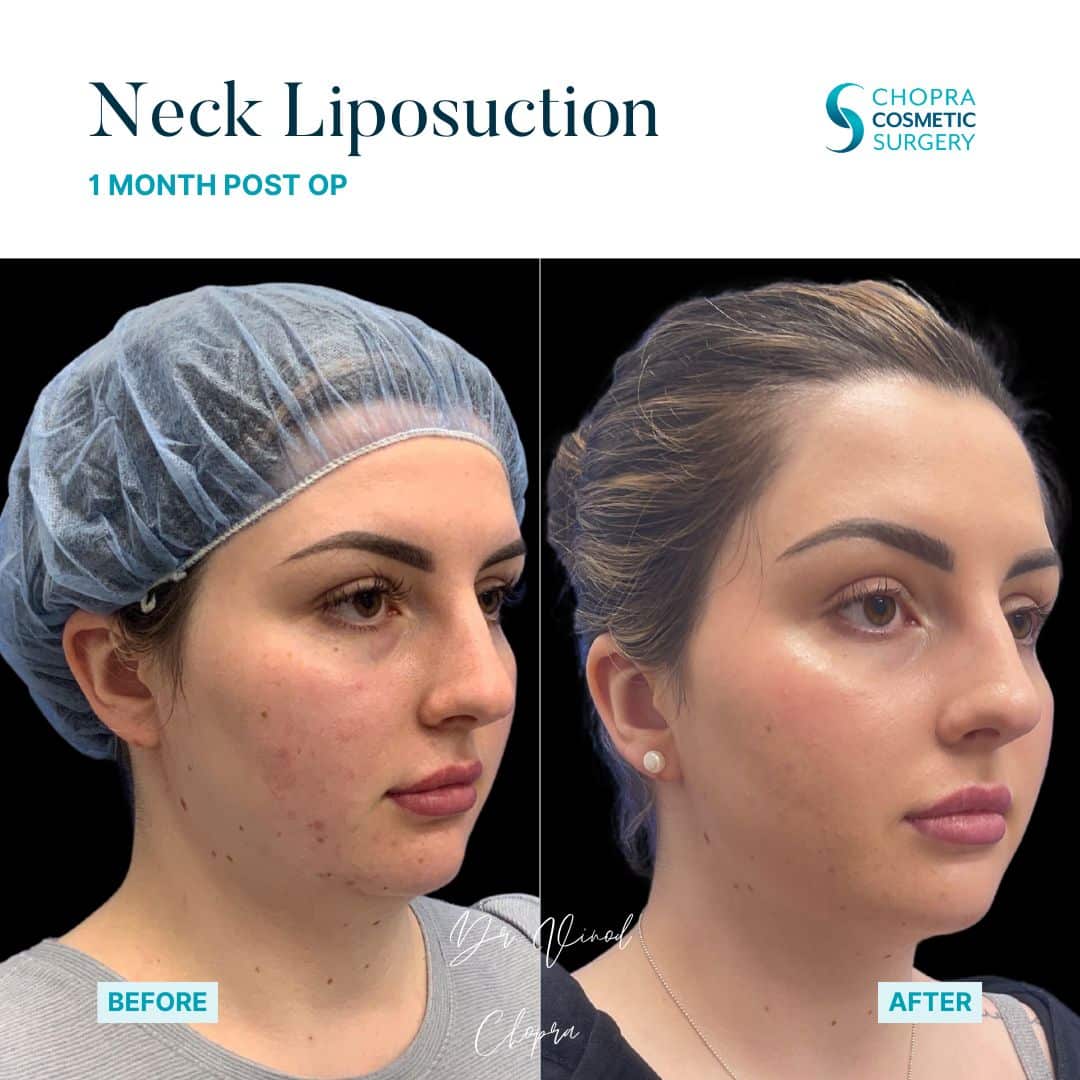 Neck Liposuction Patient Results by Dr. Vinod Chopra in Washington, D.C. and Fairfax, VA