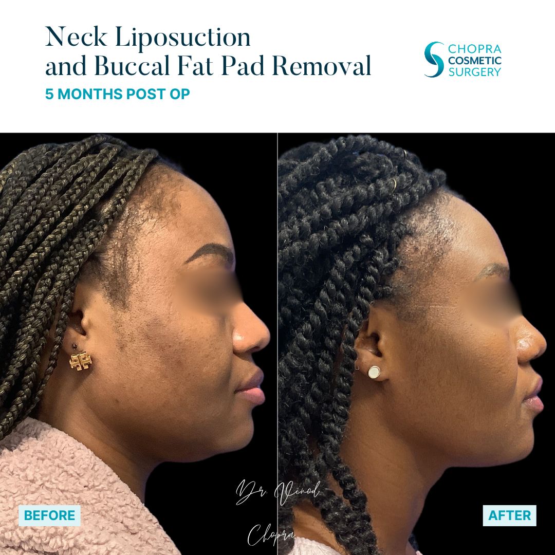 Neck Liposuction Patient Results by Dr. Vinod Chopra in Washington, D.C. and Fairfax, VA