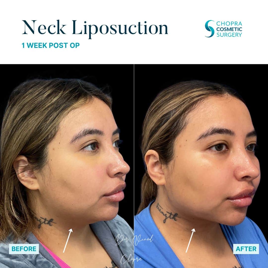 Neck Liposuction Patient Results by Dr. Vinod Chopra in Washington, D.C. and Fairfax, VA