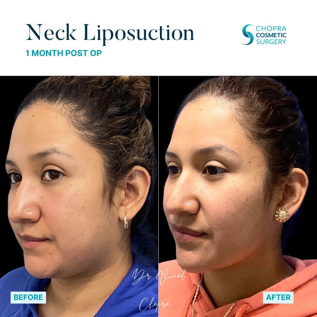 Neck Liposuction Patient Results by Dr. Vinod Chopra in Washington, D.C. and Fairfax, VA