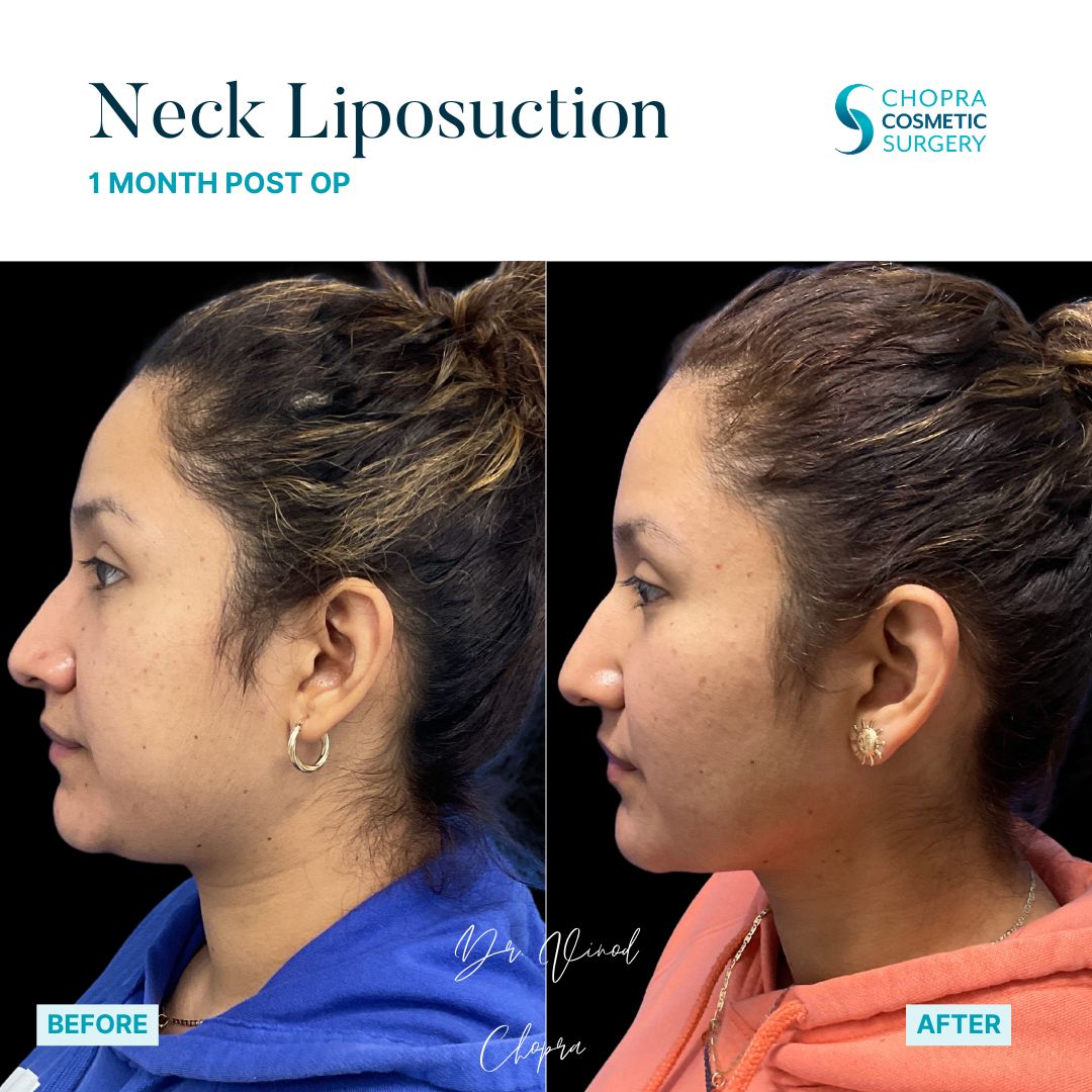 Neck Liposuction Patient Results by Dr. Vinod Chopra in Washington, D.C. and Fairfax, VA
