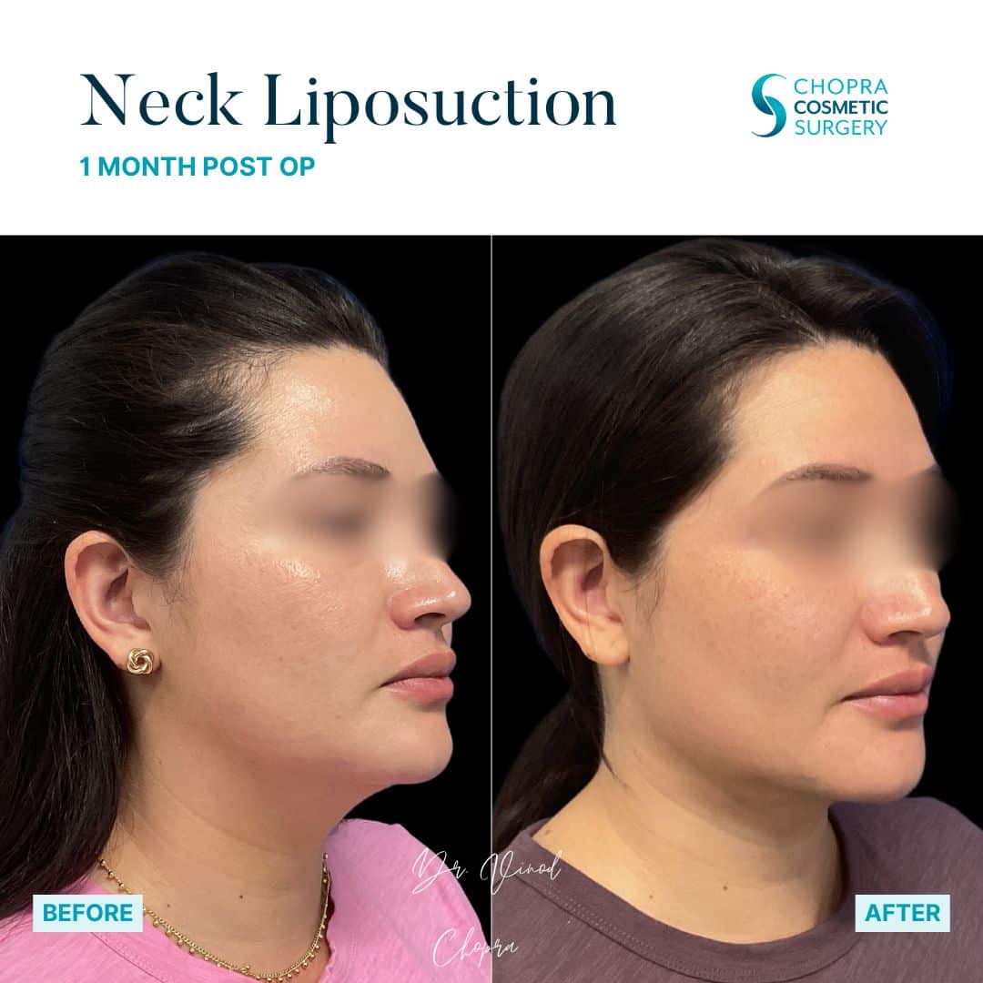 Neck Liposuction Patient Results by Dr. Vinod Chopra in Washington, D.C. and Fairfax, VA