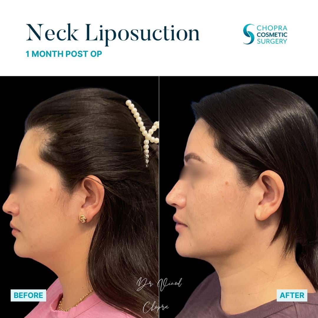 Neck Liposuction Patient Results by Dr. Vinod Chopra in Washington, D.C. and Fairfax, VA