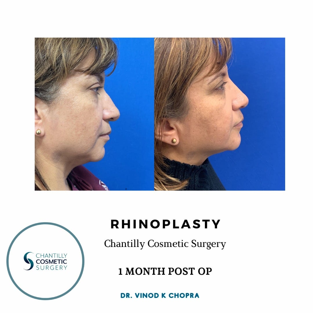 Rhinoplasty Patient Results by Dr. Vinod Chopra in Washington, D.C. and Fairfax, VA