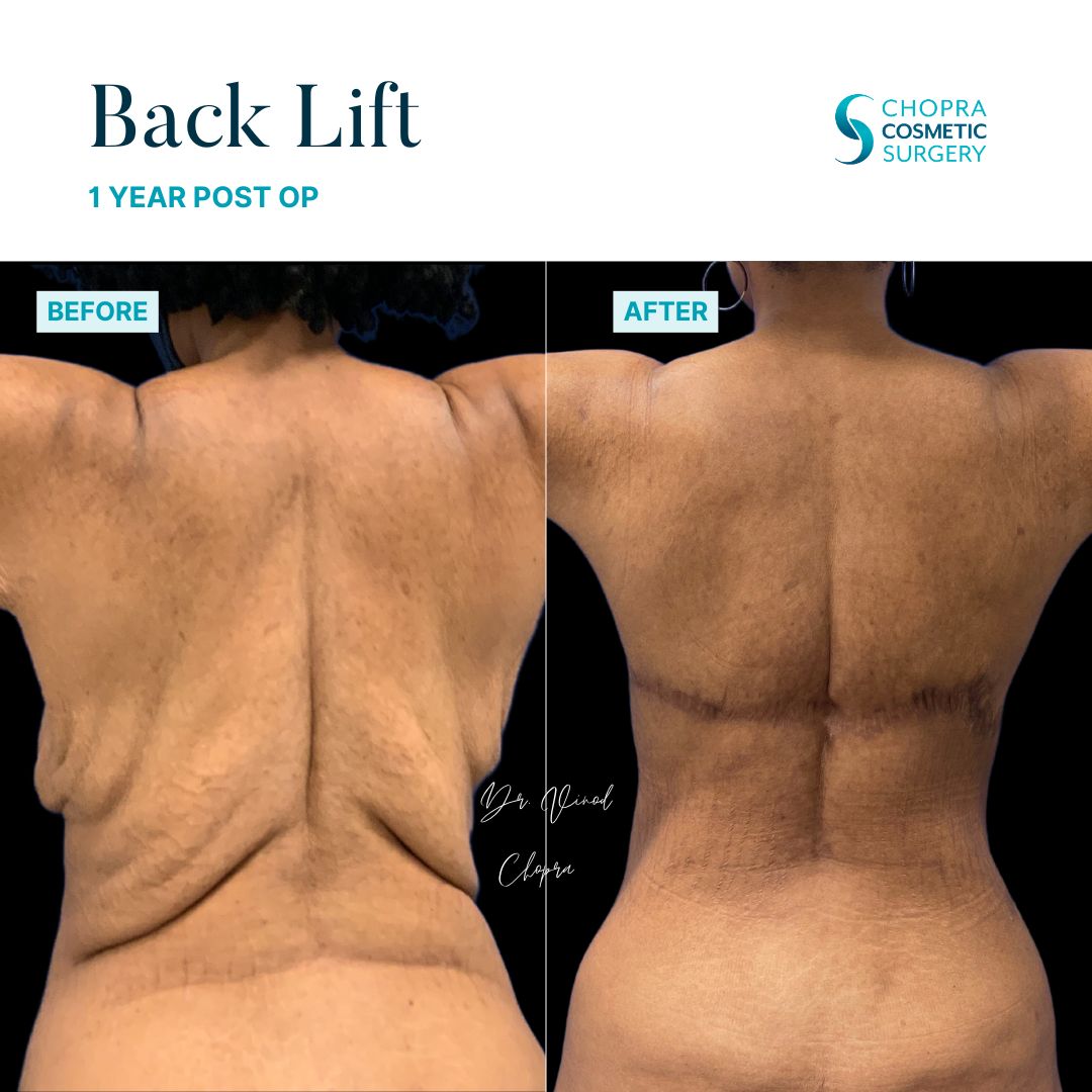 Back Lift Real Patient Results by Dr. Vinod Chopra in Washington, D.C. and Fairfax, VA