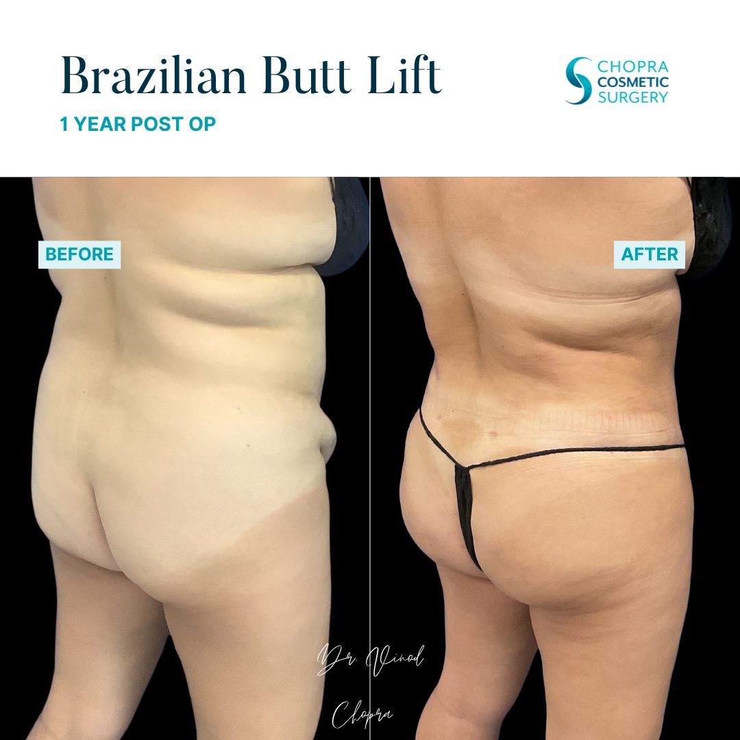 Brazilian Butt Lift Real Patient Results by Dr. Vinod Chopra in Washington, D.C. and Fairfax, VA