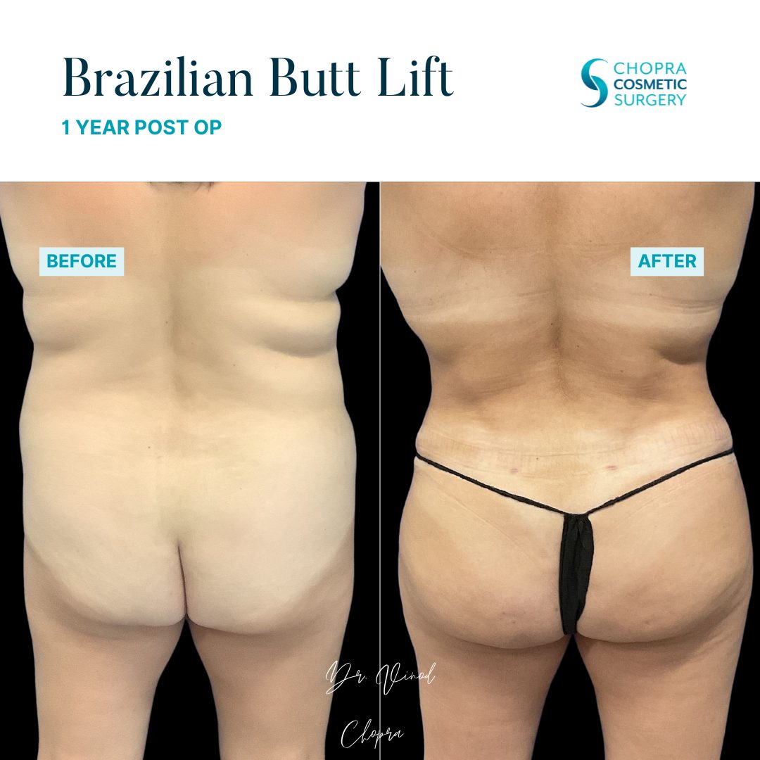 Brazilian Butt Lift Real Patient Results by Dr. Vinod Chopra in Washington, D.C. and Fairfax, VA