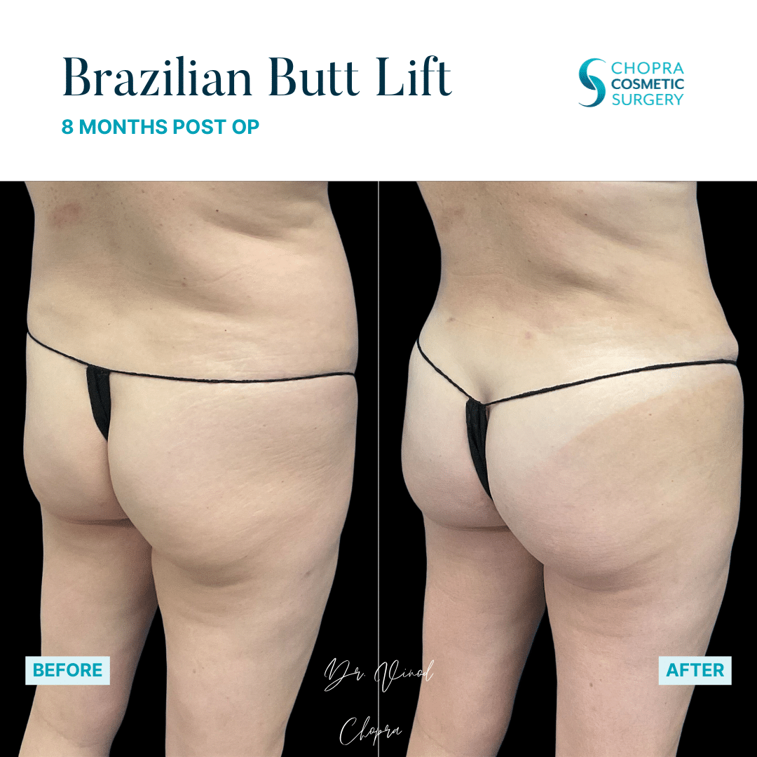 Brazilian Butt Lift Real Patient Results by Dr. Vinod Chopra in Washington, D.C. and Fairfax, VA
