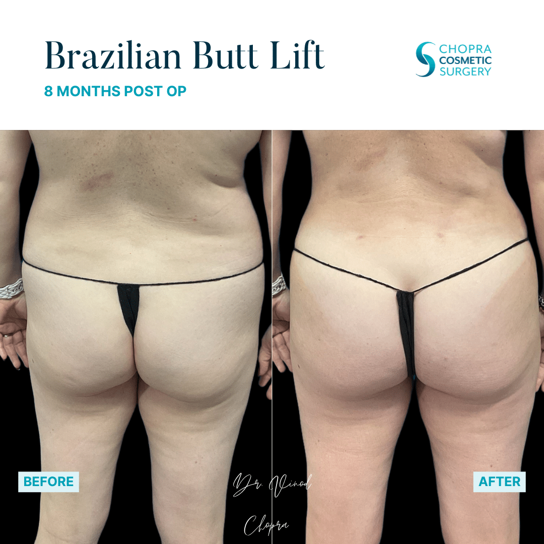 Brazilian Butt Lift Real Patient Results by Dr. Vinod Chopra in Washington, D.C. and Fairfax, VA