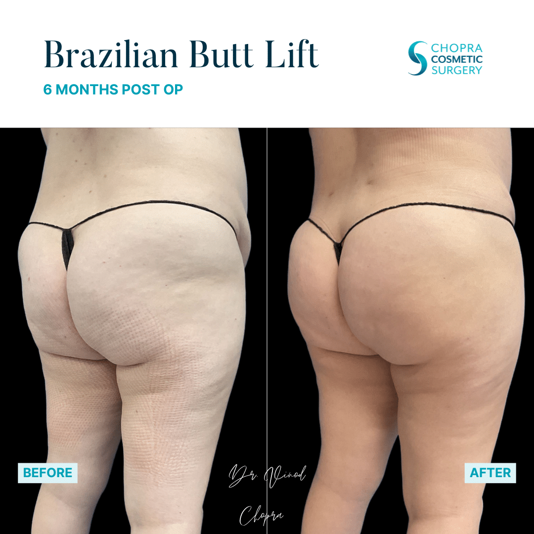 Brazilian Butt Lift Real Patient Results by Dr. Vinod Chopra in Washington, D.C. and Fairfax, VA