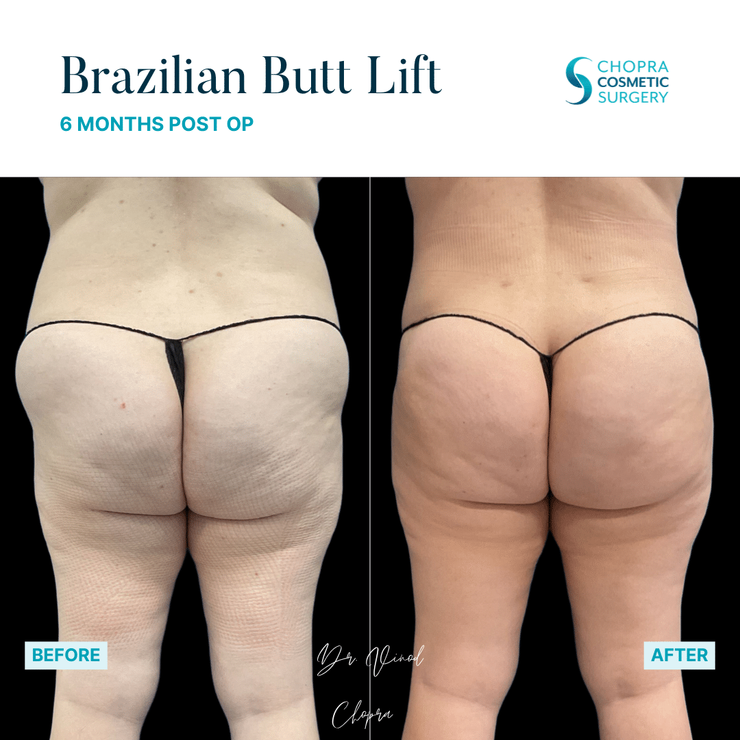 Brazilian Butt Lift Real Patient Results by Dr. Vinod Chopra in Washington, D.C. and Fairfax, VA