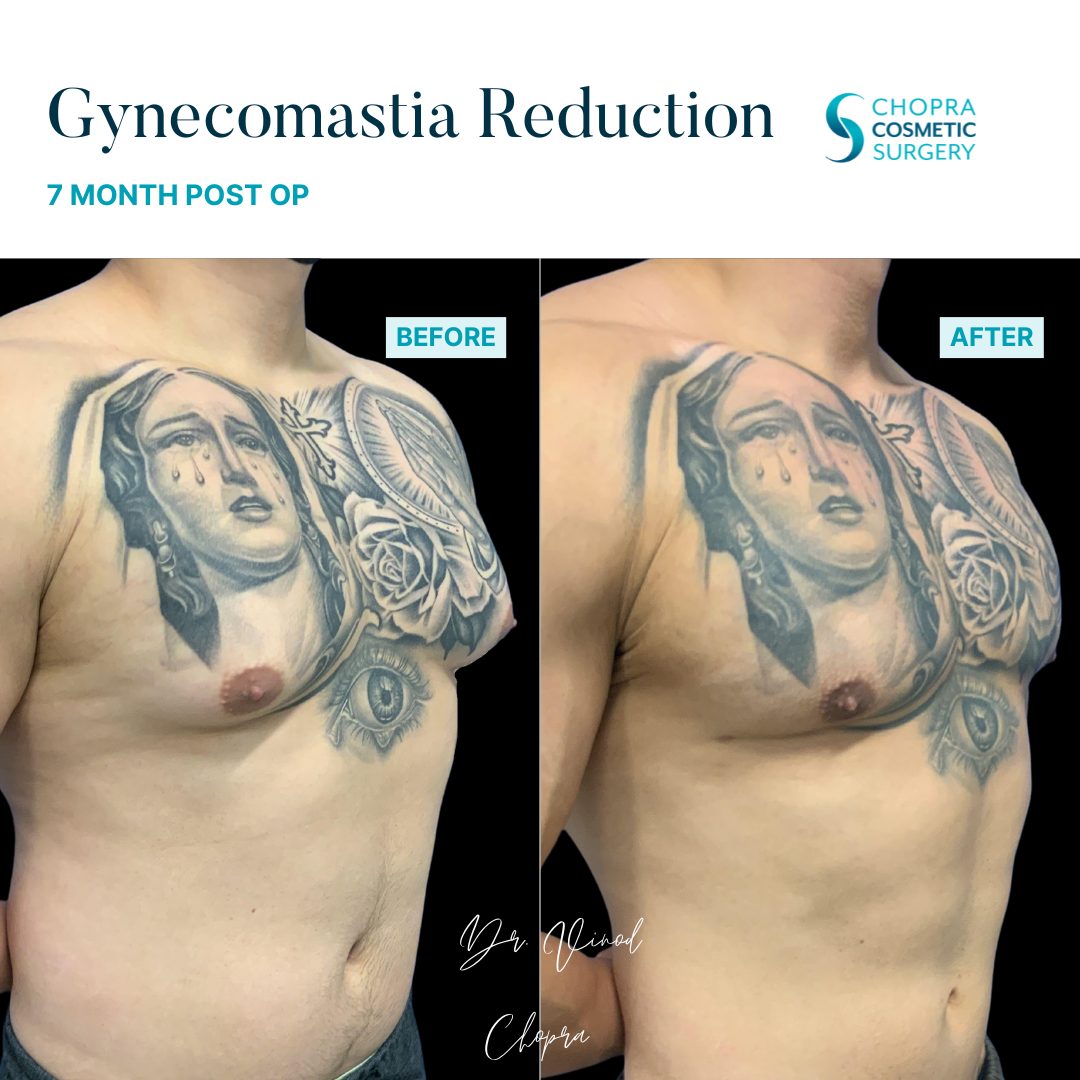 Gynecomastia Real Patient Results by Dr. Vinod Chopra in Washington, D.C. and Fairfax, VA