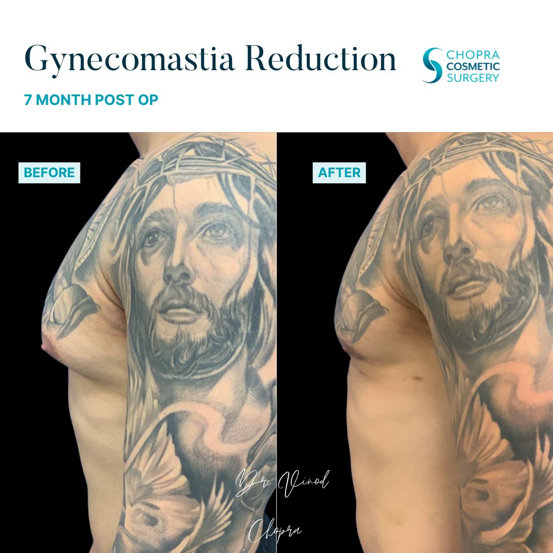 Gynecomastia Real Patient Results by Dr. Vinod Chopra in Washington, D.C. and Fairfax, VA