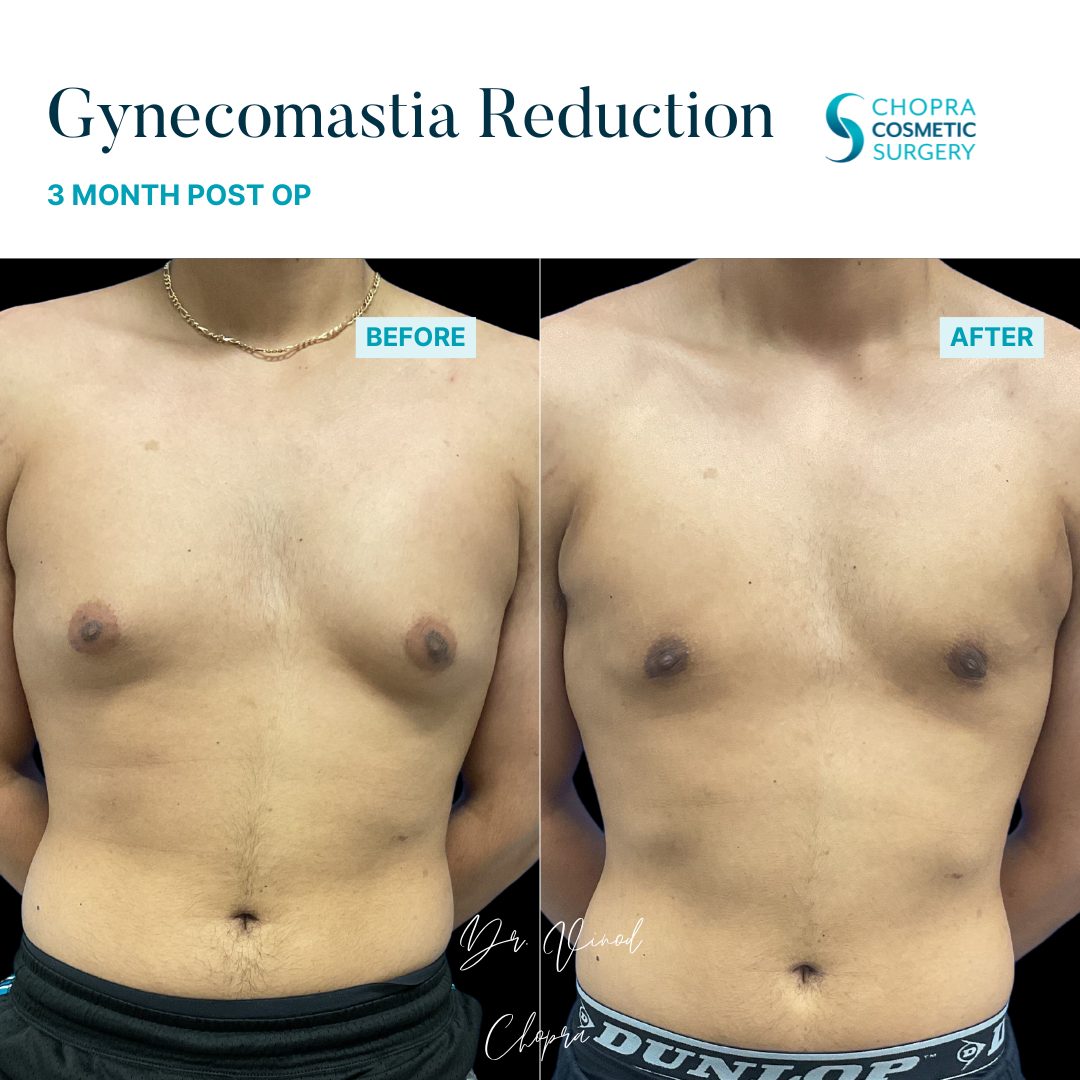 Gynecomastia Real Patient Results by Dr. Vinod Chopra in Washington, D.C. and Fairfax, VA