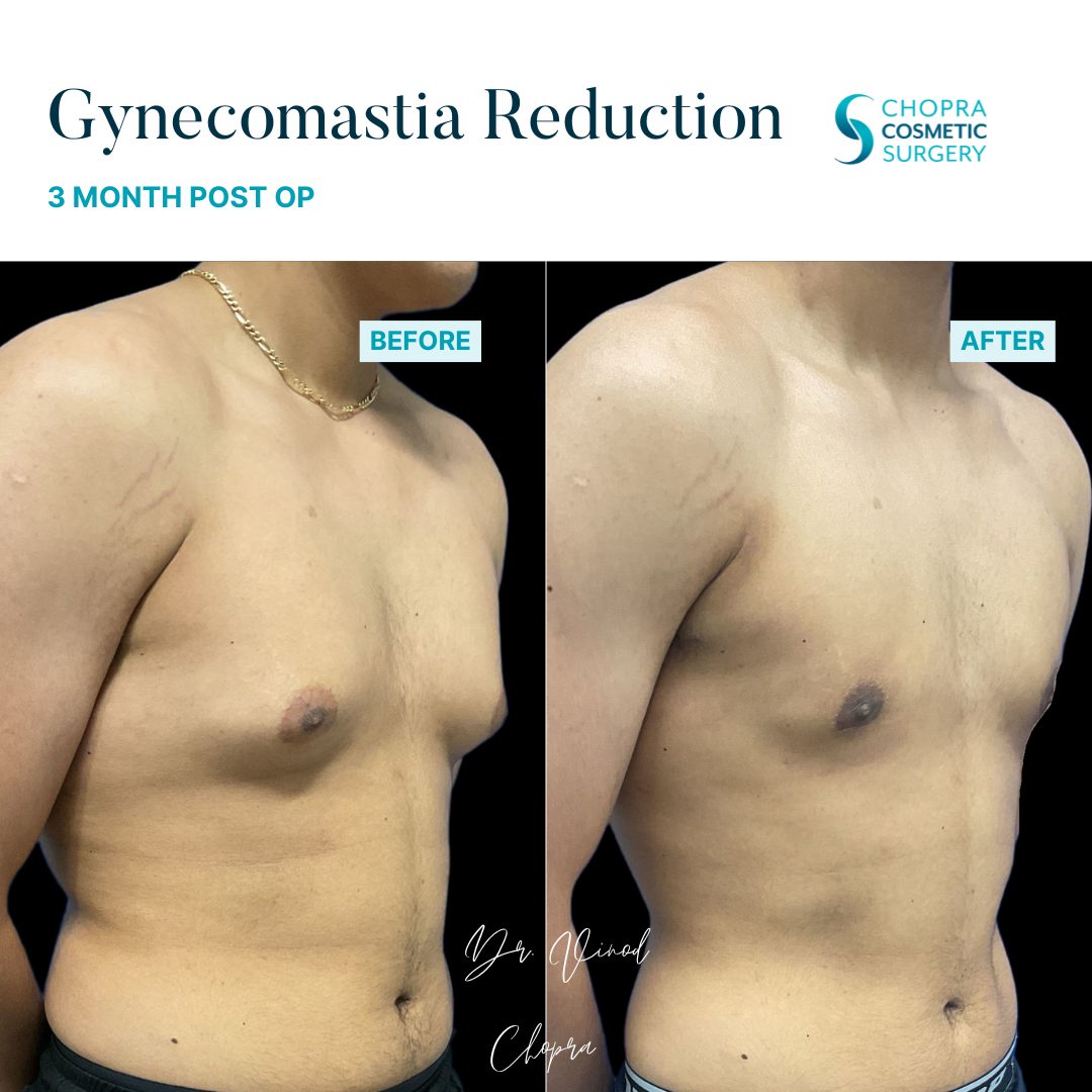 Gynecomastia Real Patient Results by Dr. Vinod Chopra in Washington, D.C. and Fairfax, VA