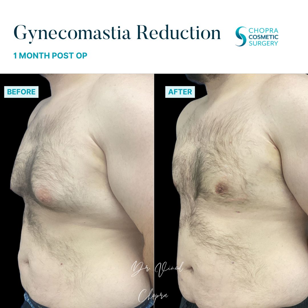 Gynecomastia Real Patient Results by Dr. Vinod Chopra in Washington, D.C. and Fairfax, VA