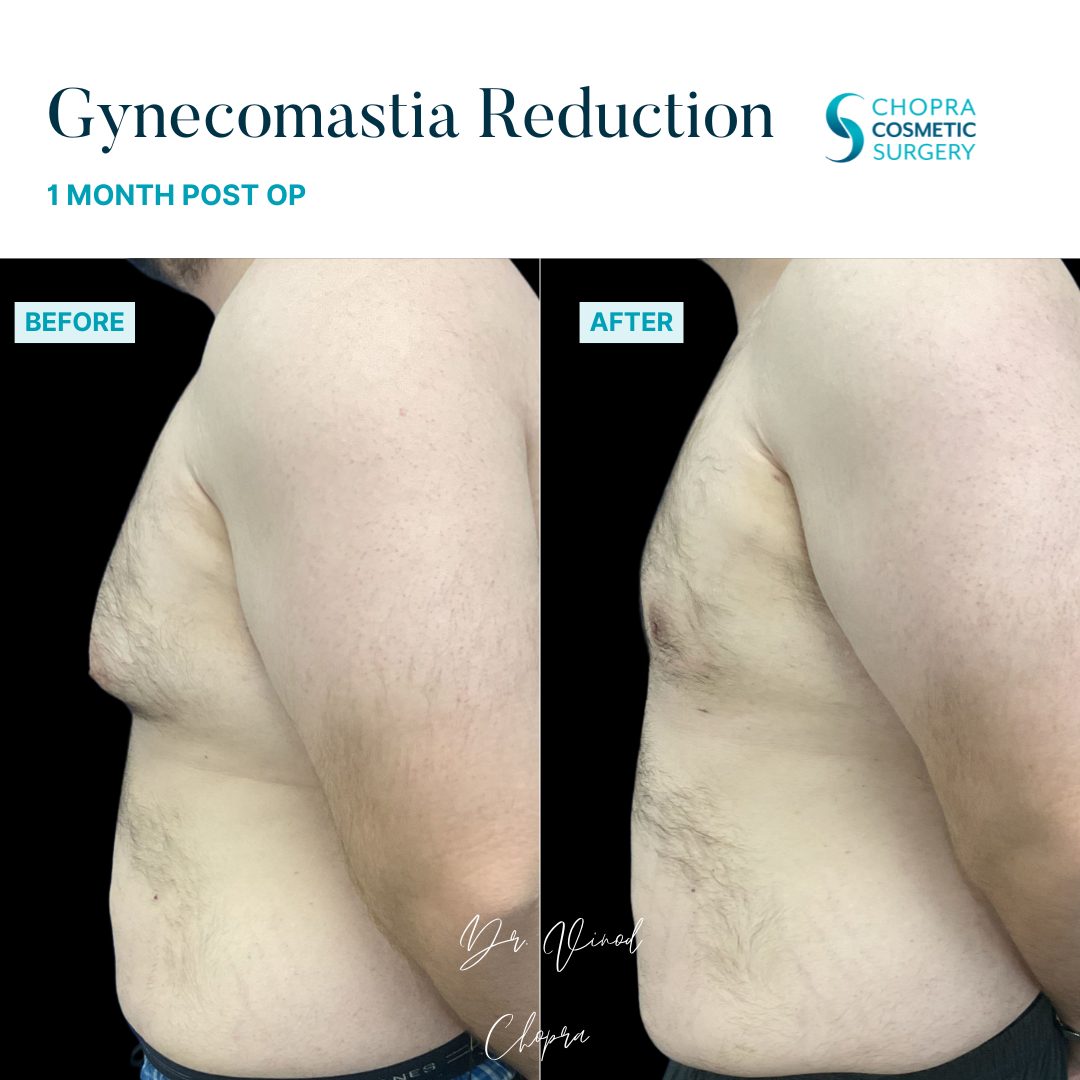 Gynecomastia Real Patient Results by Dr. Vinod Chopra in Washington, D.C. and Fairfax, VA