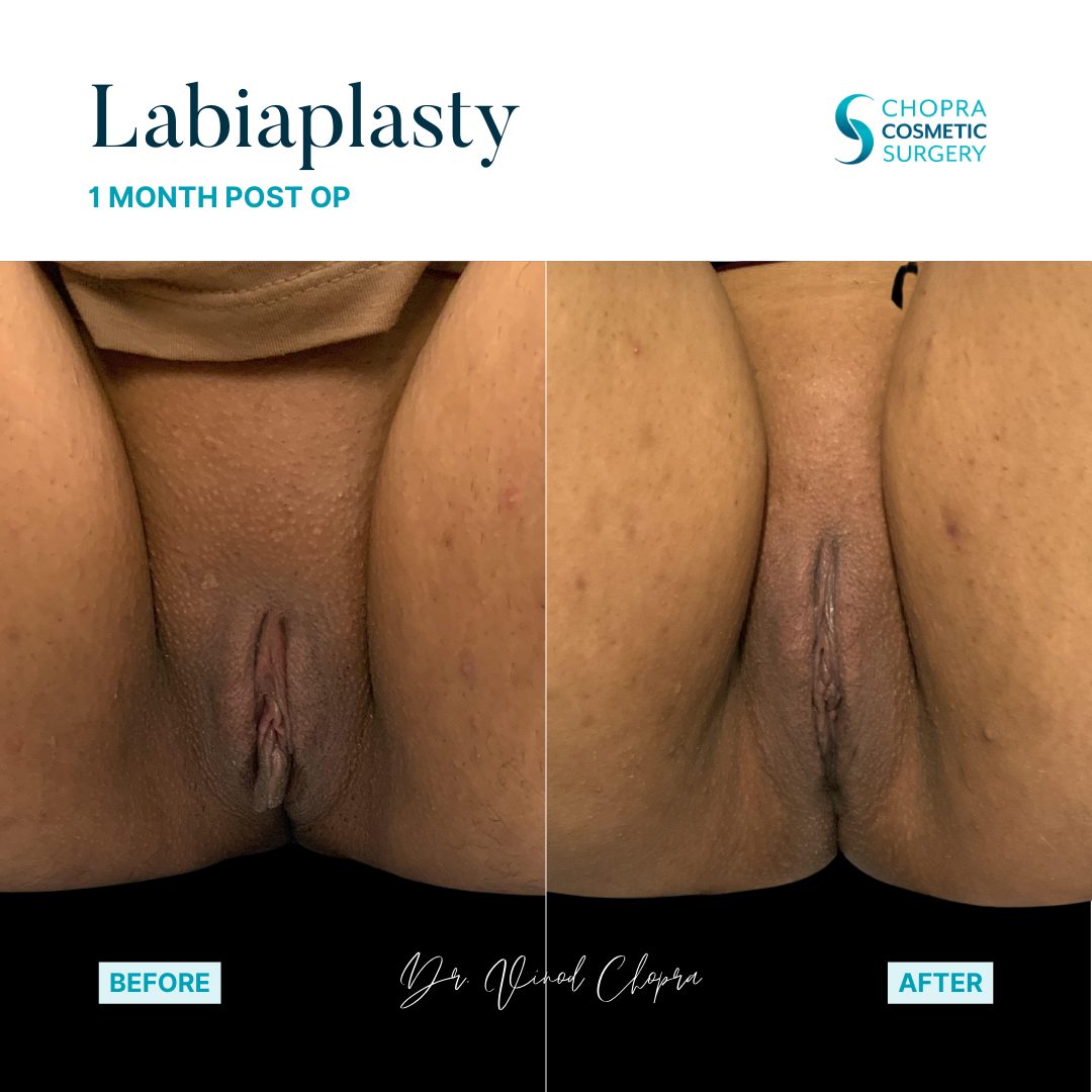 Labiaplasty Real Patient Results by Dr. Vinod Chopra in Washington, D.C. and Fairfax, VA