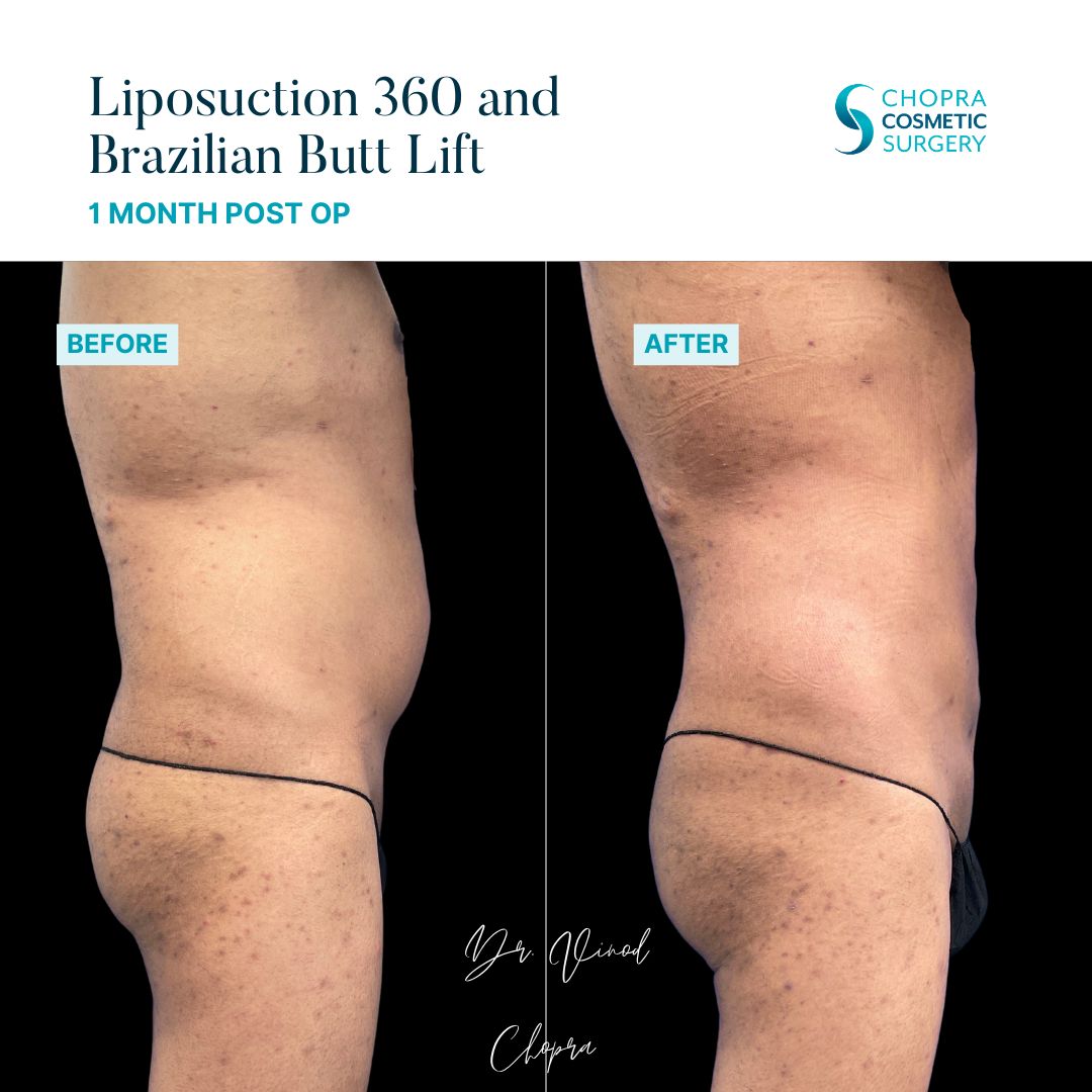 Liposuction Real Patient Results by Dr. Vinod Chopra in Washington, D.C. and Fairfax, VA