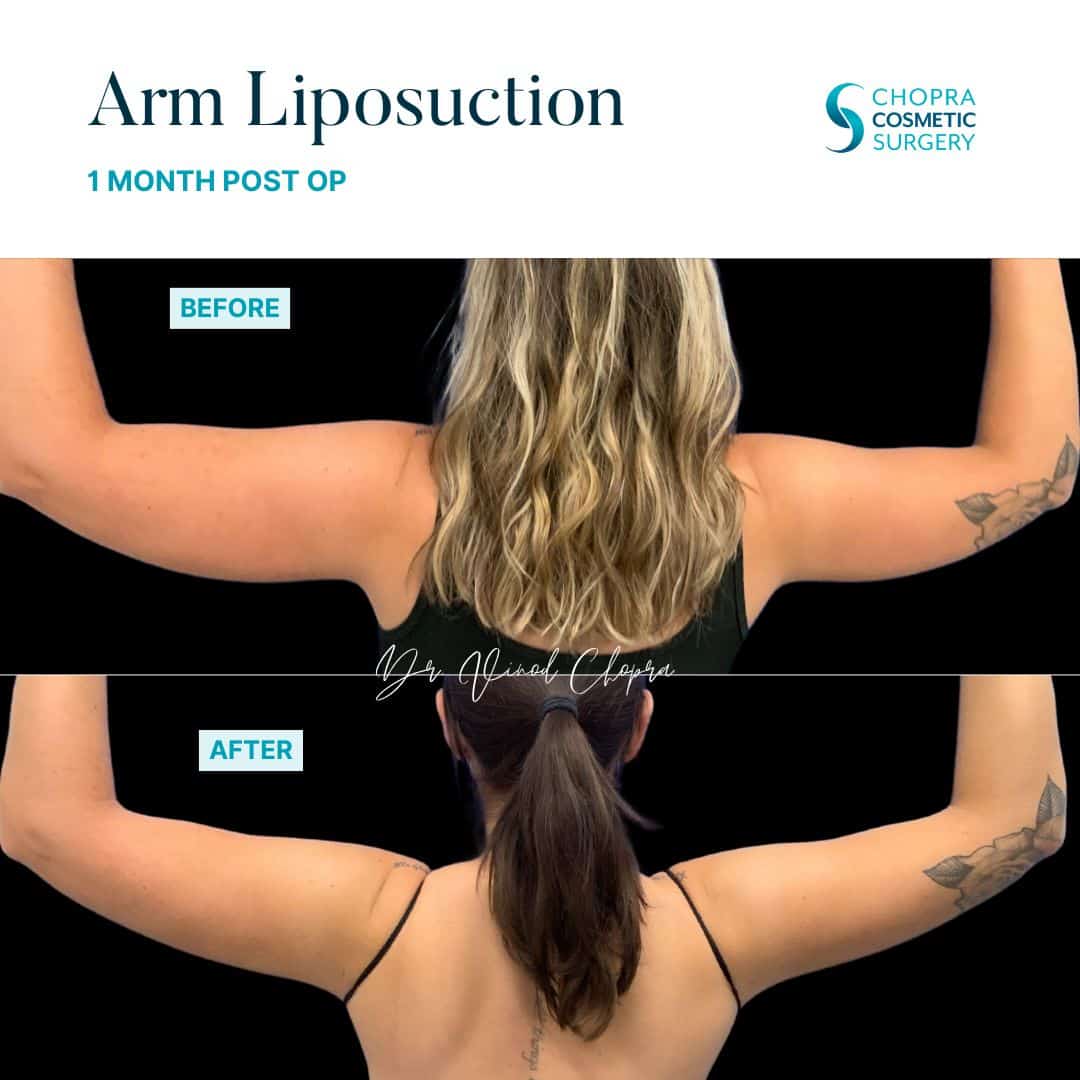 Liposuction Real Patient Results by Dr. Vinod Chopra in Washington, D.C. and Fairfax, VA