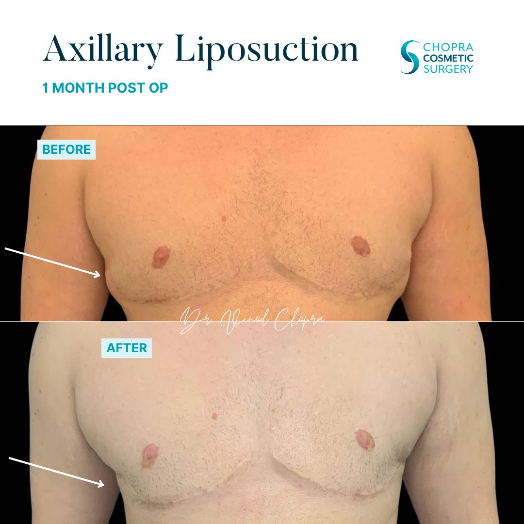 Liposuction Real Patient Results by Dr. Vinod Chopra in Washington, D.C. and Fairfax, VA