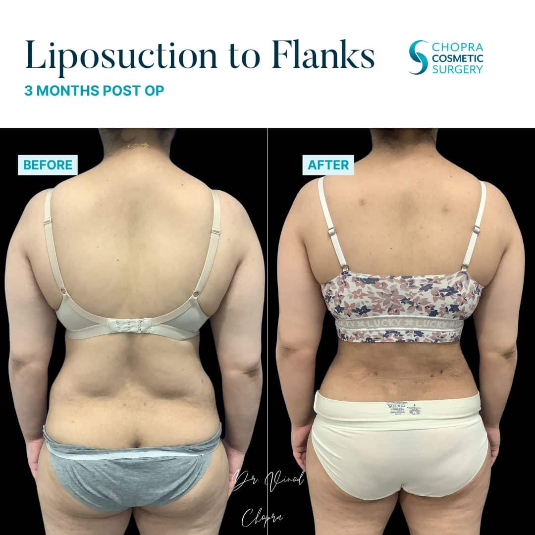 Liposuction Real Patient Results by Dr. Vinod Chopra in Washington, D.C. and Fairfax, VA