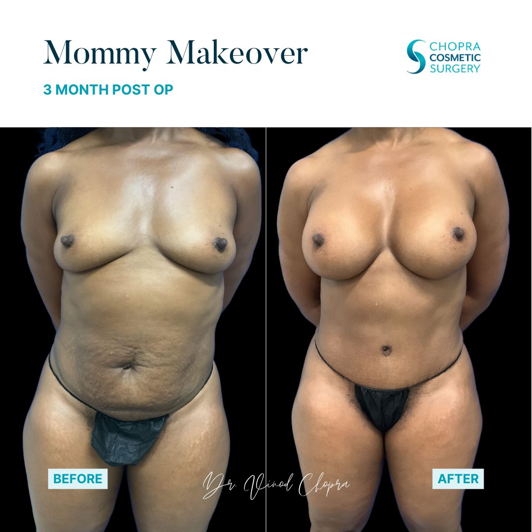 Mommy Makeover Real Patient Results by Dr. Vinod Chopra in Washington, D.C. and Fairfax, VA
