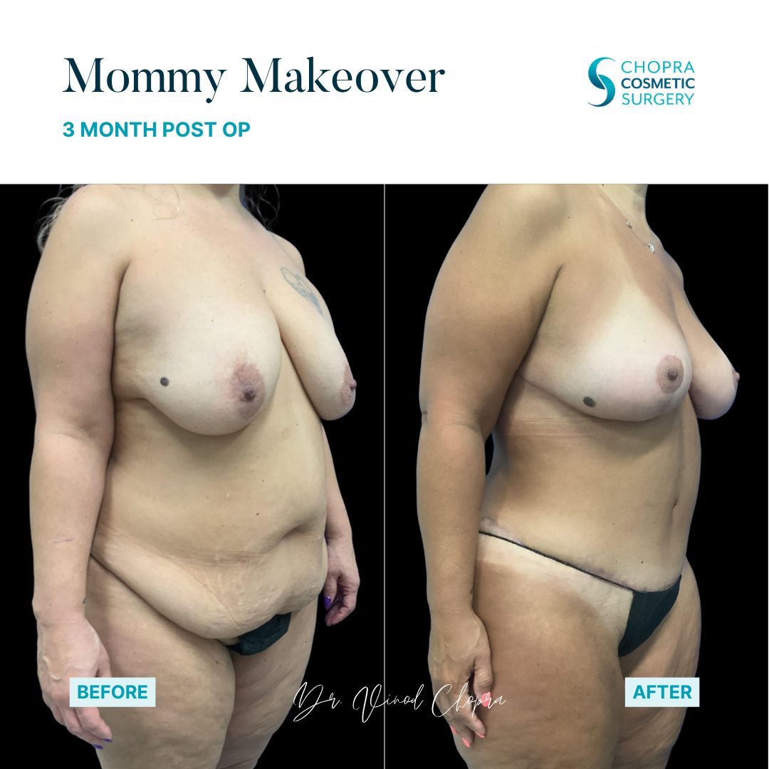 Mommy Makeover Real Patient Results by Dr. Vinod Chopra in Washington, D.C. and Fairfax, VA