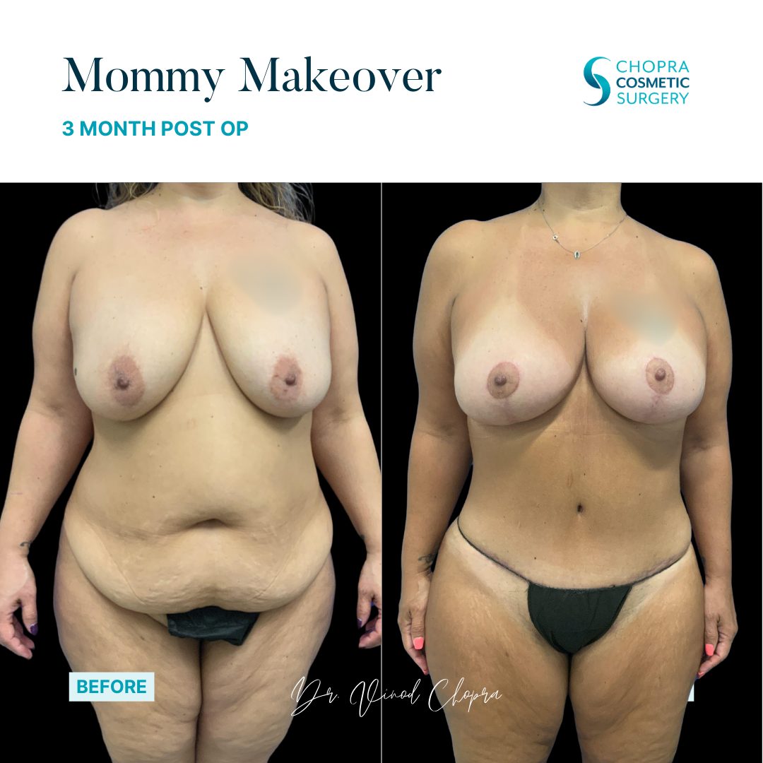 Mommy Makeover Real Patient Results by Dr. Vinod Chopra in Washington, D.C. and Fairfax, VA